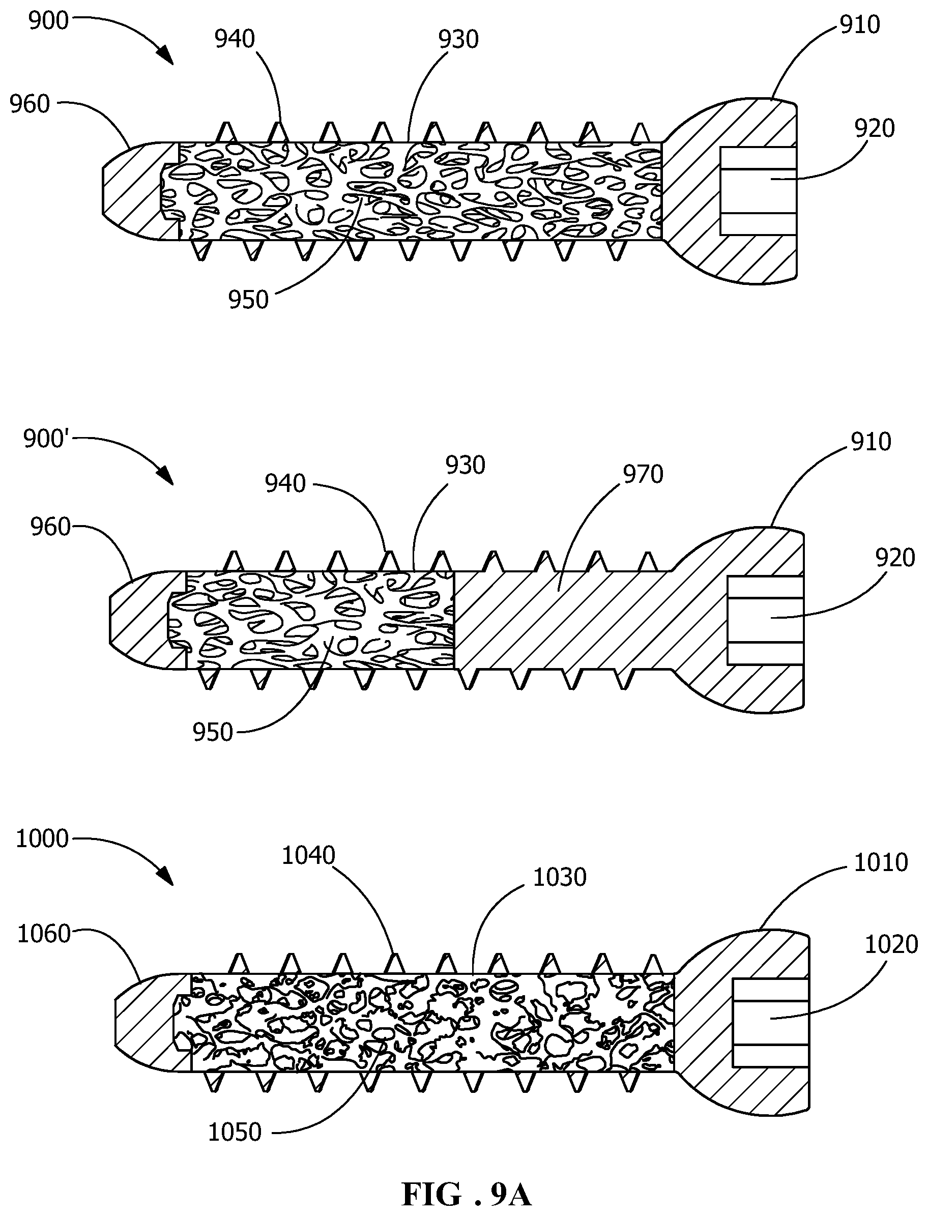 Patent US12376895 Figure 9 – Implants for tissue fixation and fusion