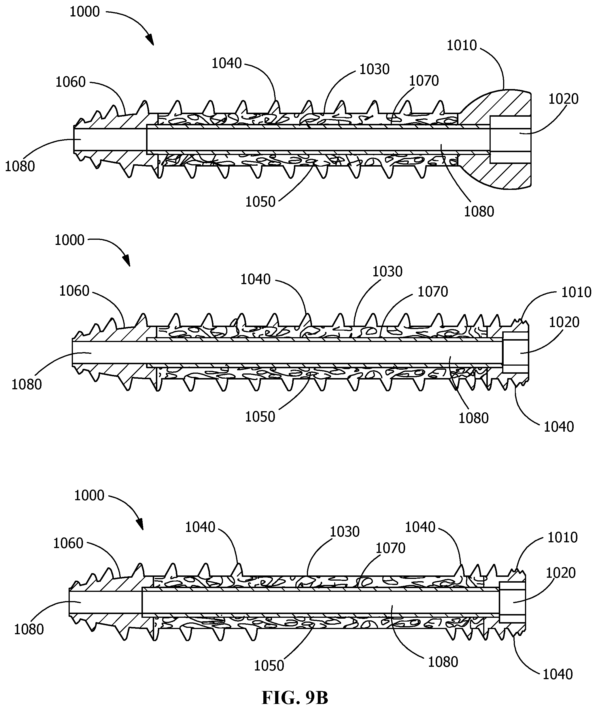 Patent US12376895 Figure 10 – Implants for tissue fixation and fusion