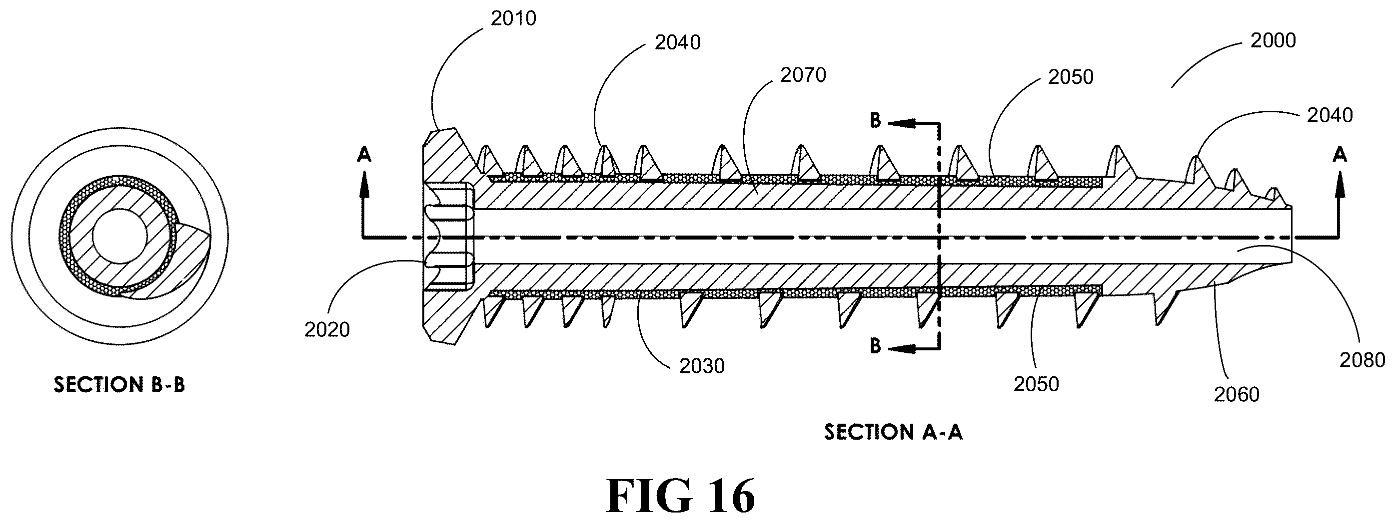 Patent US12376895 Figure 14 – Implants for tissue fixation and fusion
