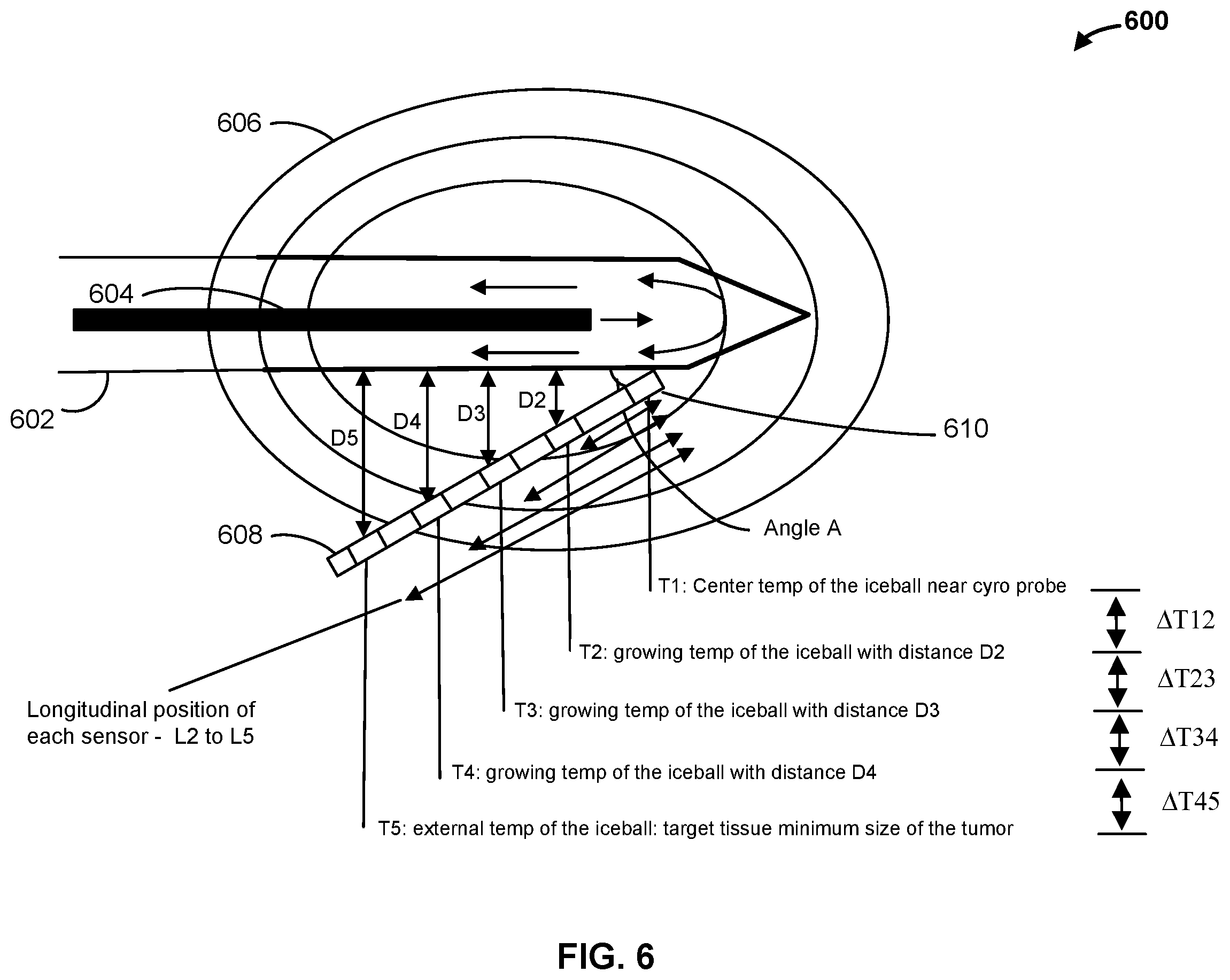 Patent US12376897 Figure 6 – Apparatuses and methods for the control and optimization of ice formation during cryoablation treatments