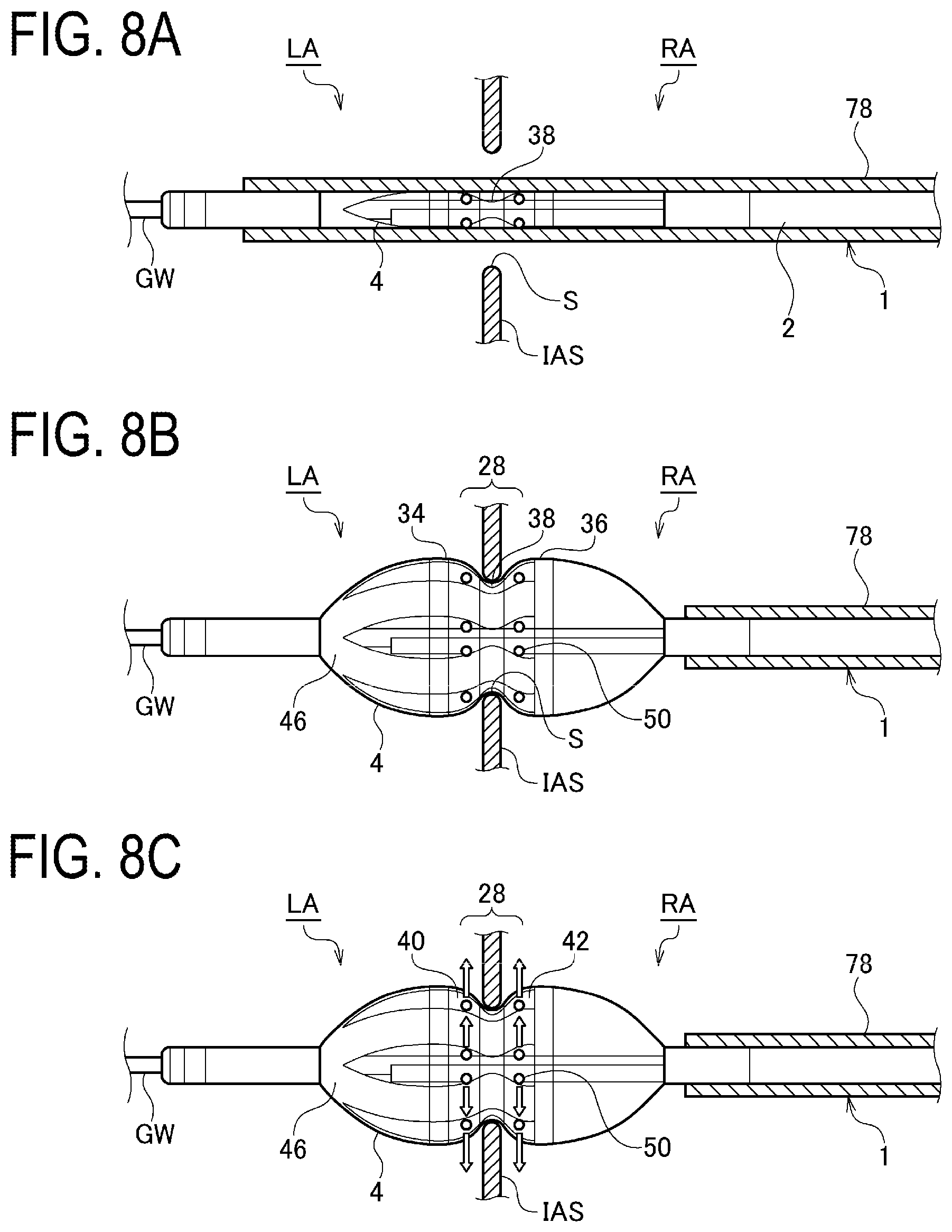 Patent US12376902 Figure 8 – Balloon-type electrode catheter and method of actuating balloon-type electrode catheter