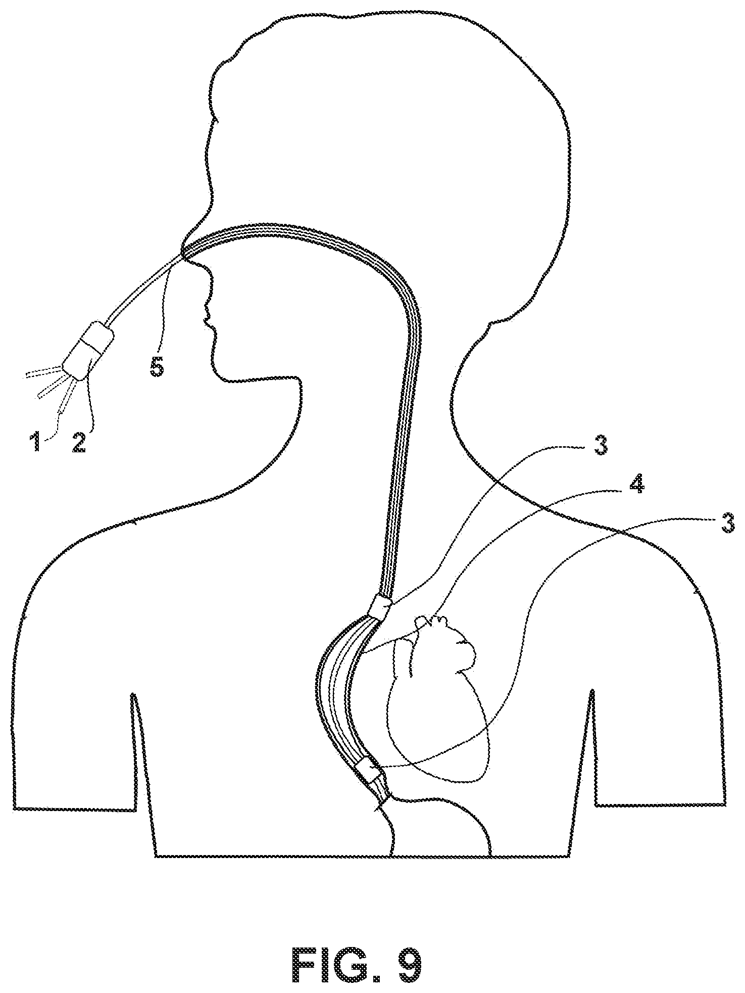 Patent US12376908 Figure 3 – Traction device for curved balloon catheter and traction method