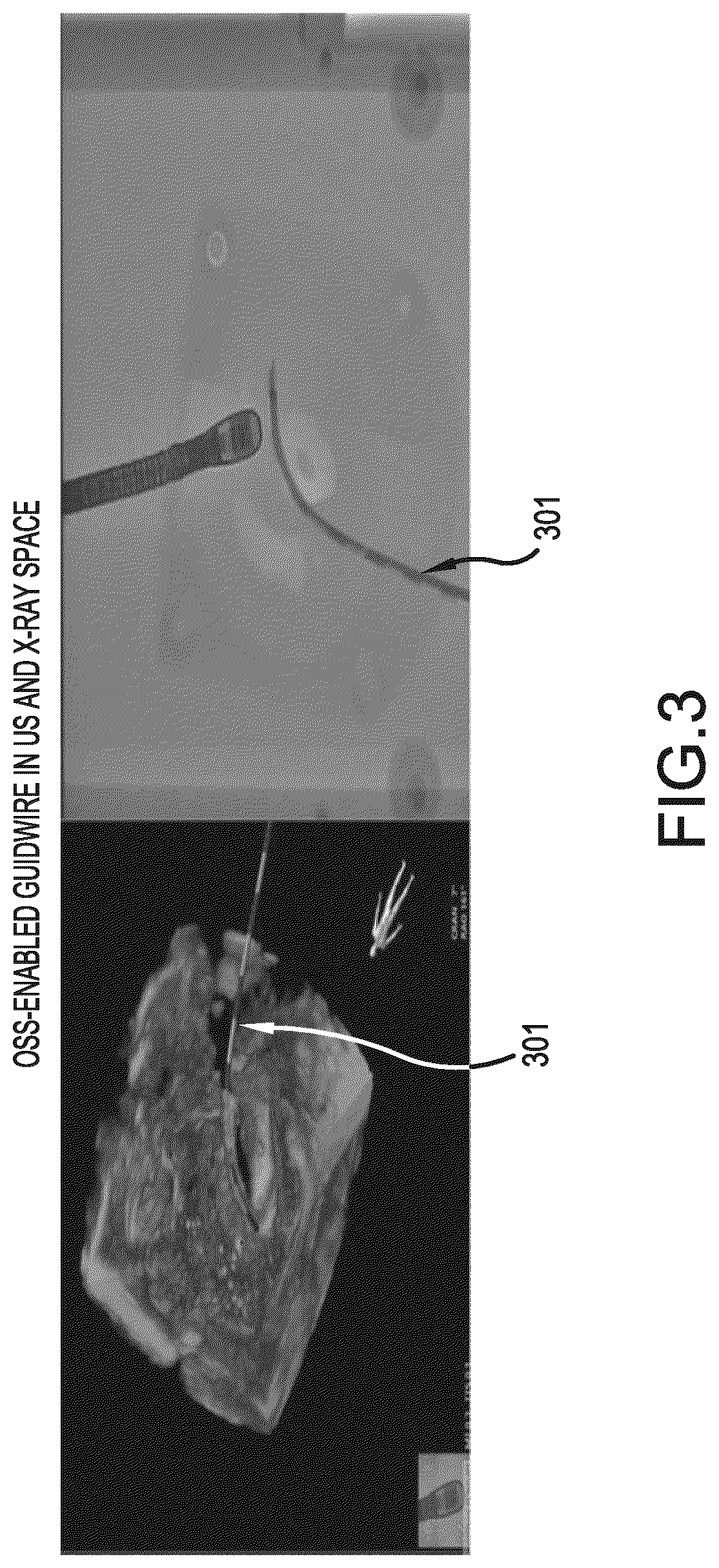 Patent US12376911 Figure 3 – Interventional medical device tracking
