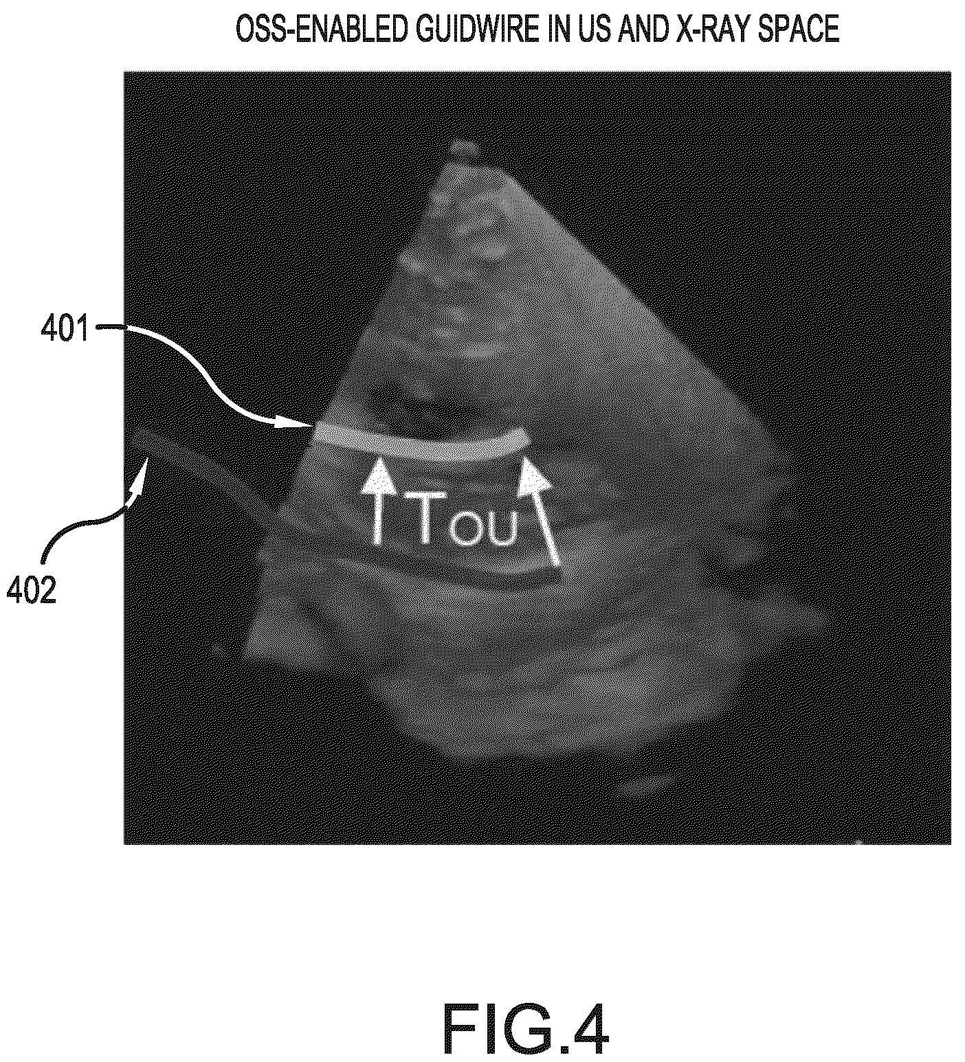 Patent US12376911 Figure 4 – Interventional medical device tracking