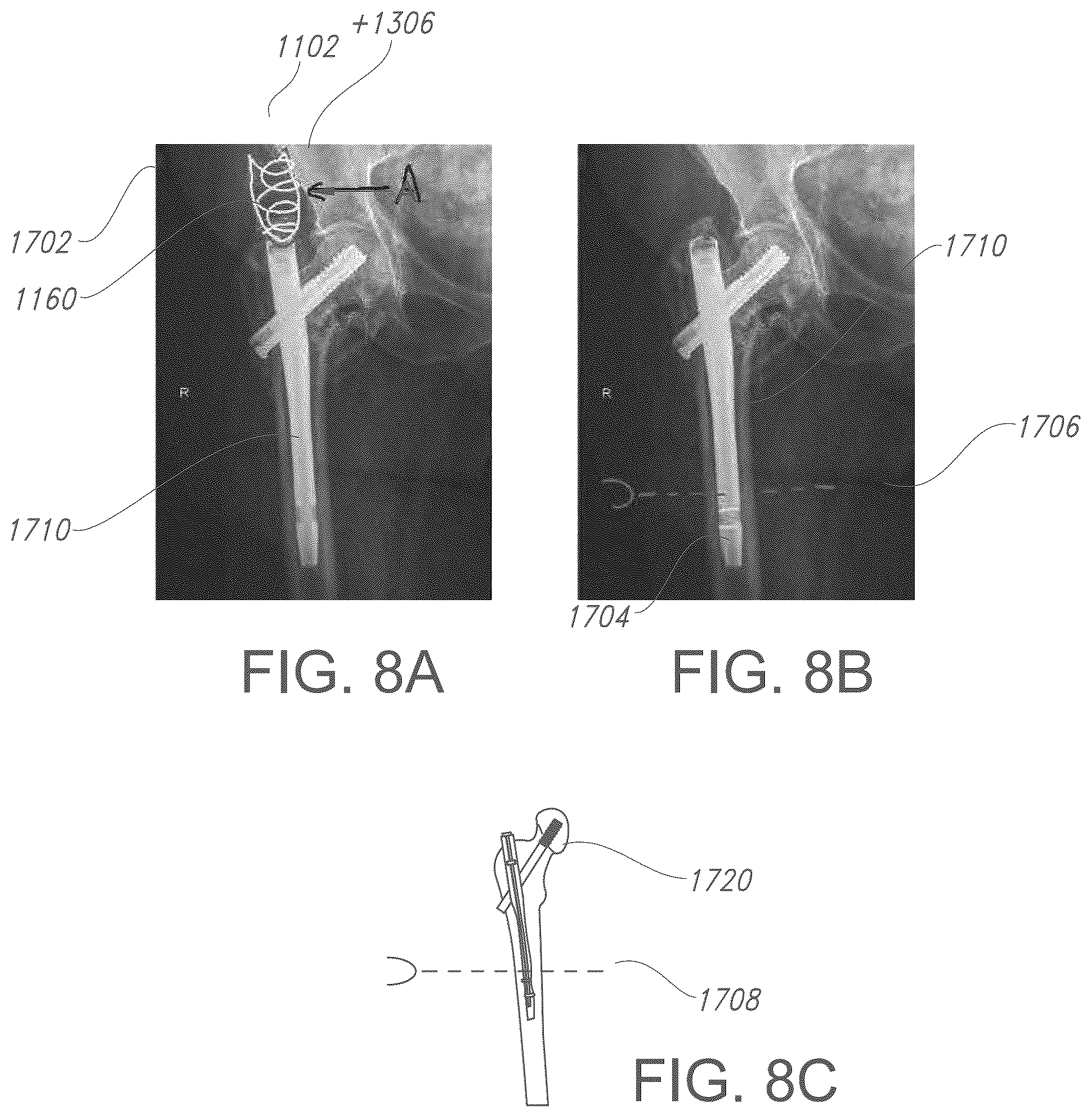 Patent US12376913 Figure 8 – Three-dimensional dual fiducial-sensor trackable device and method of use