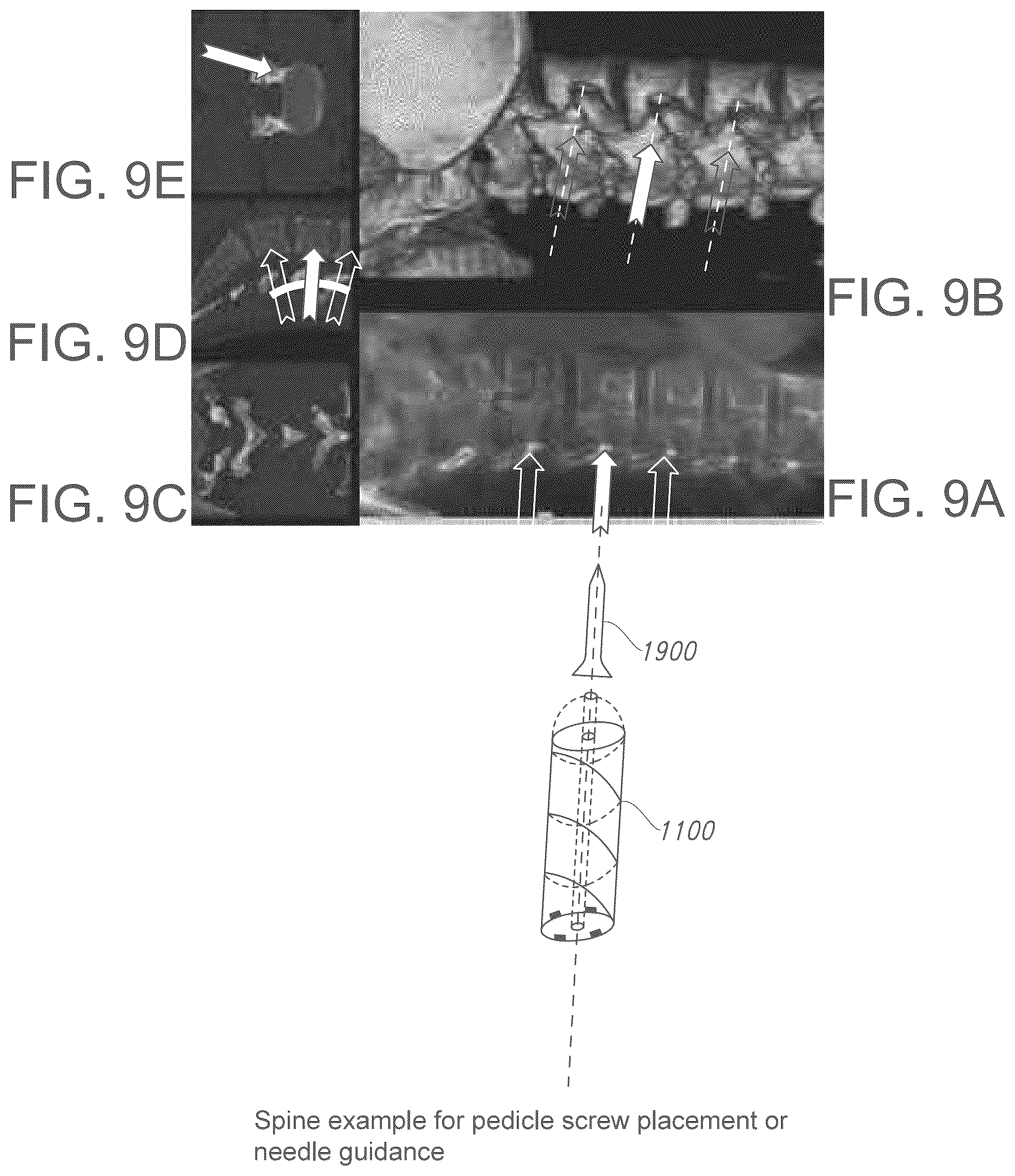 Patent US12376913 Figure 9 – Three-dimensional dual fiducial-sensor trackable device and method of use