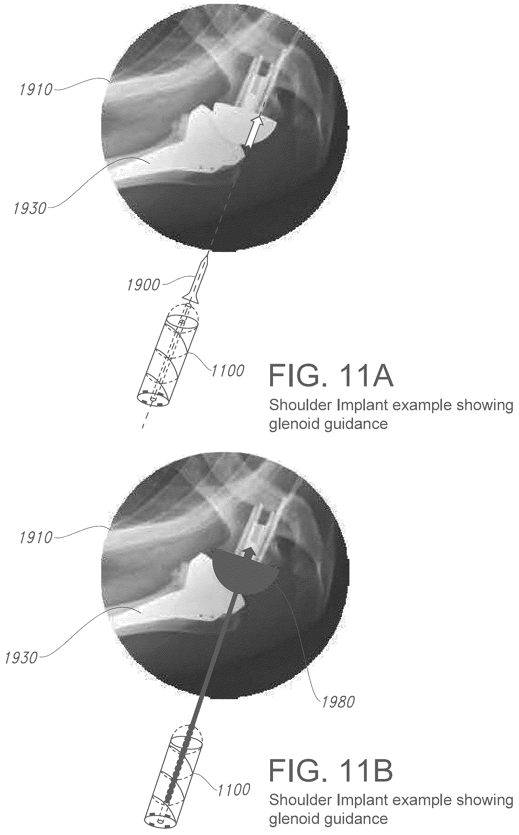 Patent US12376913 Figure 11 – Three-dimensional dual fiducial-sensor trackable device and method of use