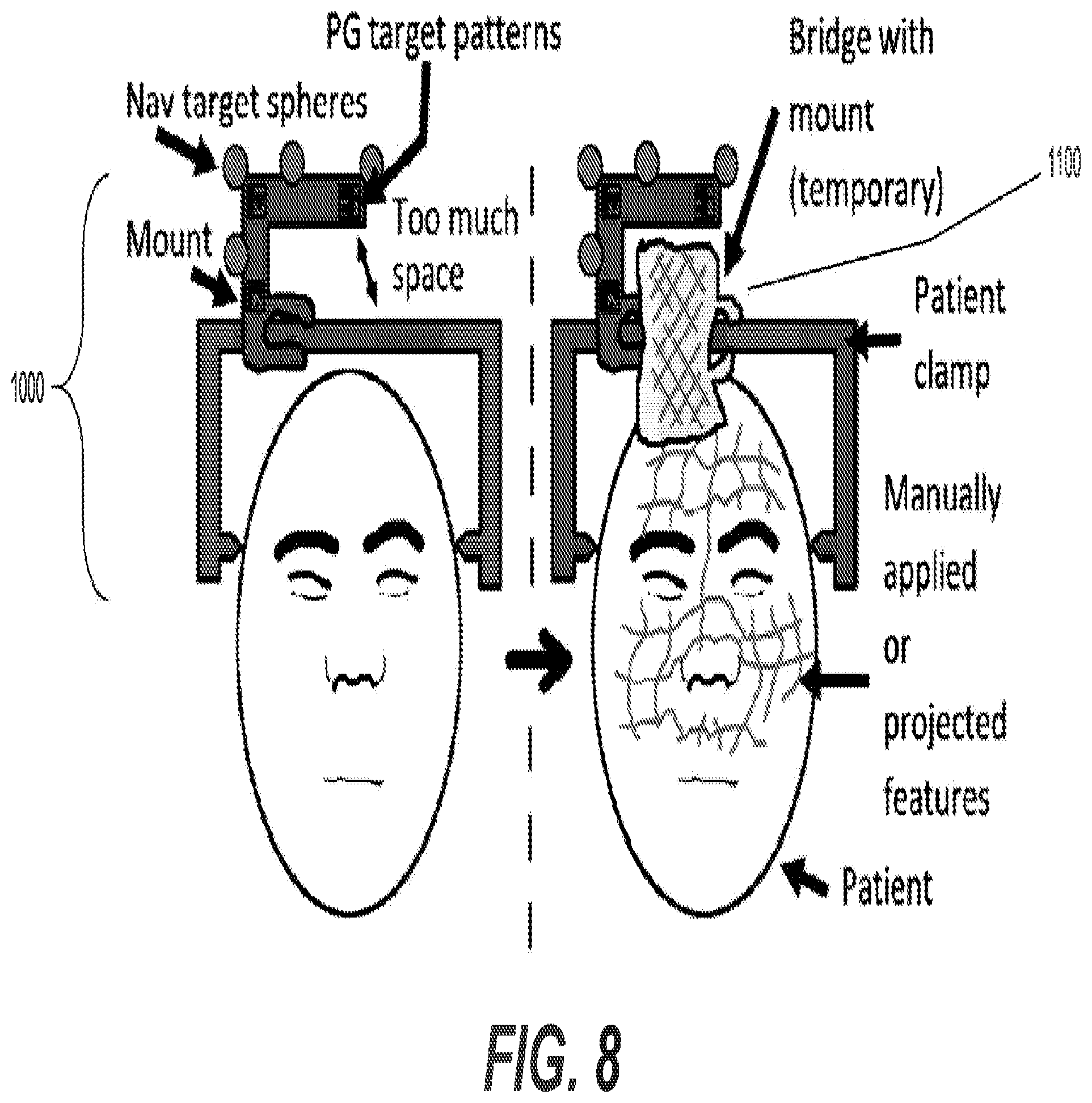 Patent US12376915 Figure 11 – Automated touchless registration for surgical navigation