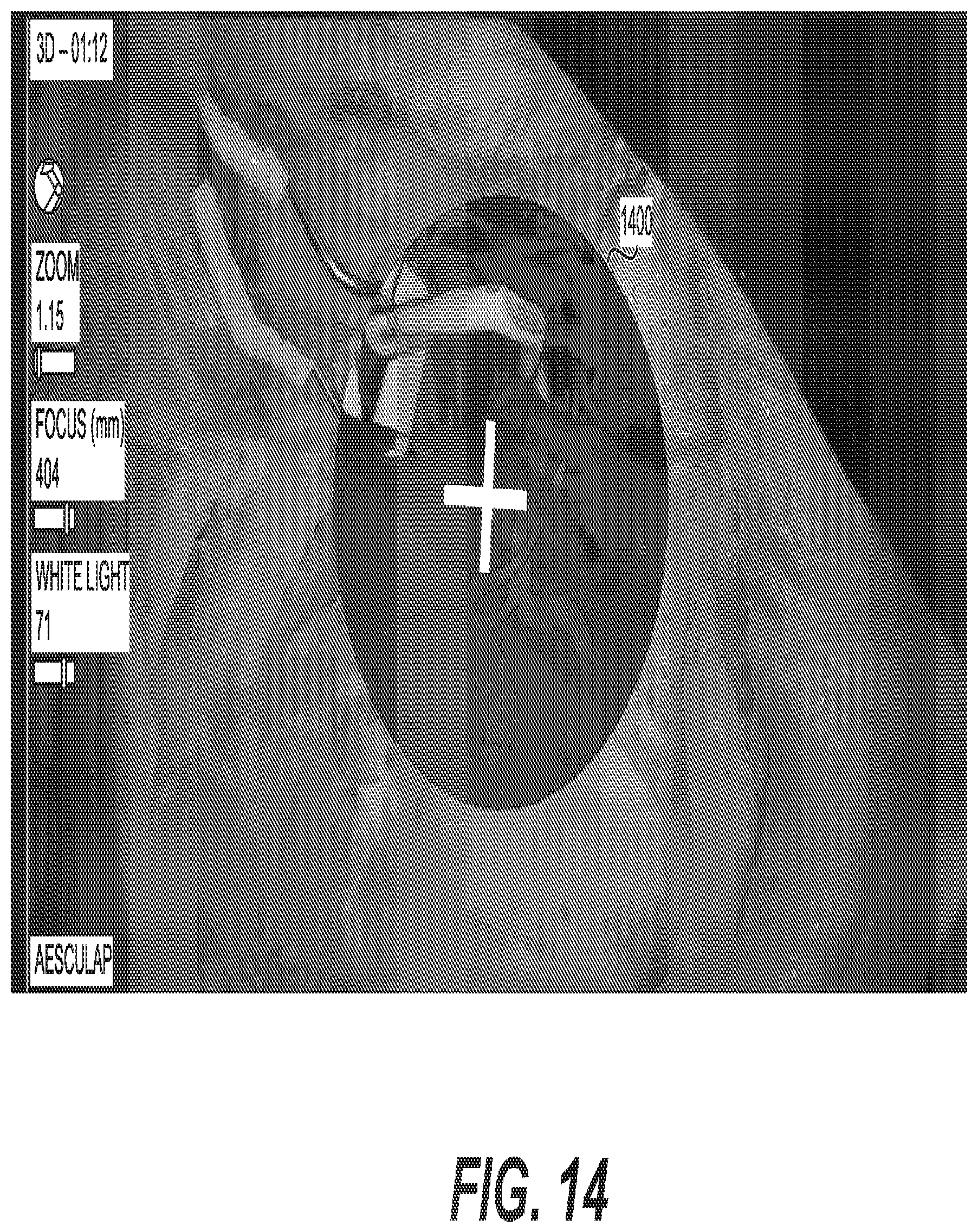 Patent US12376915 Figure 17 – Automated touchless registration for surgical navigation