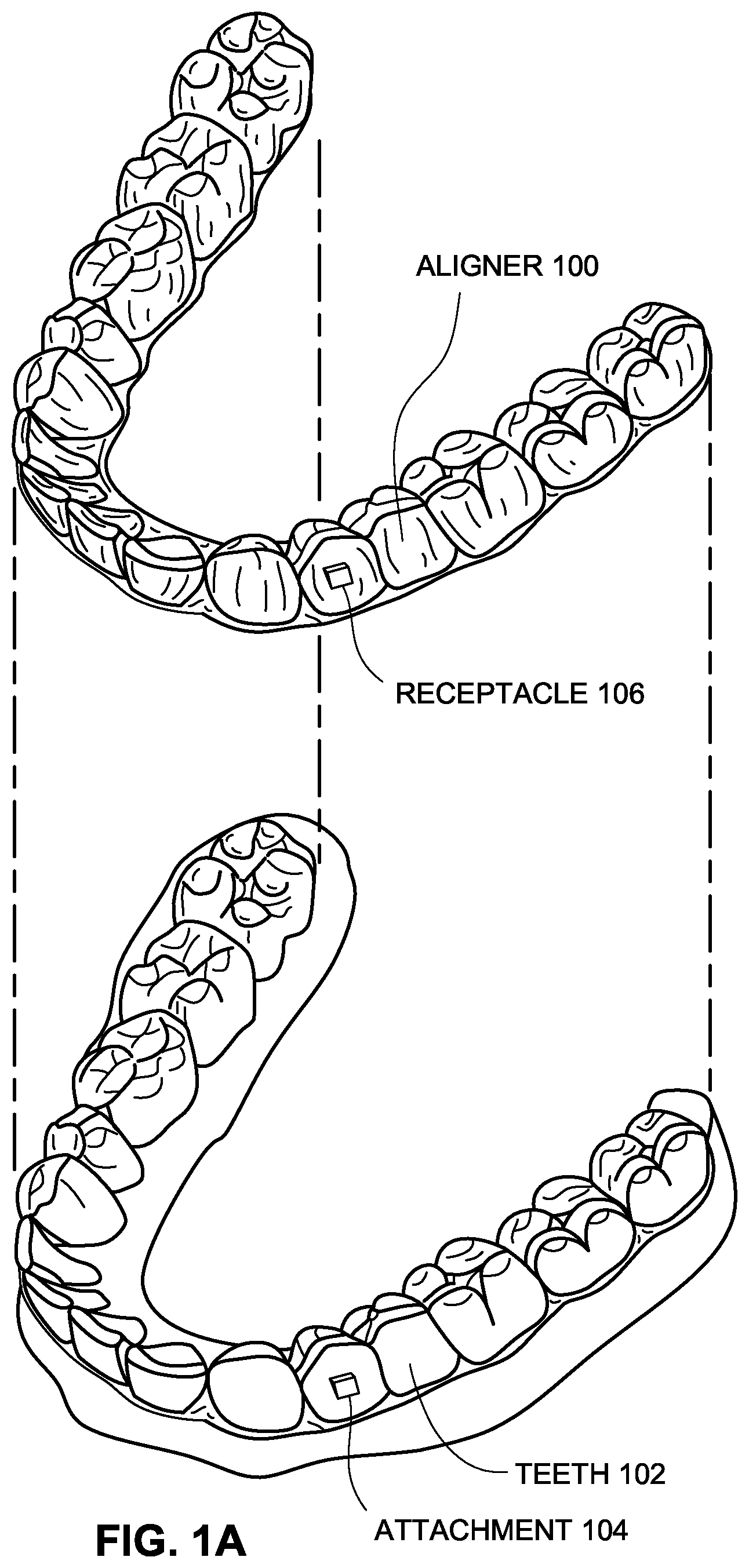 Patent US12376945 Figure 1 – Orthodontic appliances with discontinuities and elastics
