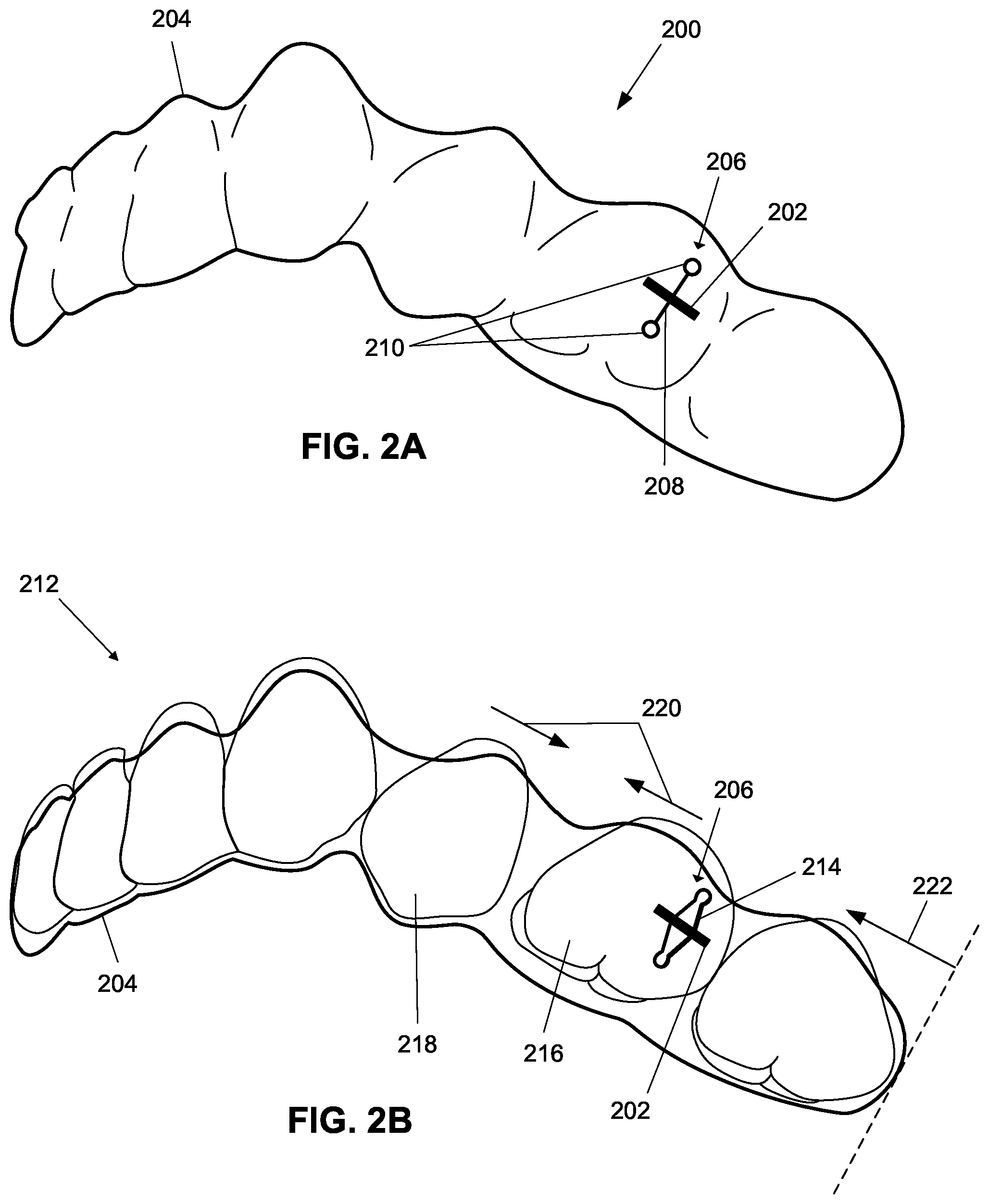 Patent US12376945 Figure 4 – Orthodontic appliances with discontinuities and elastics