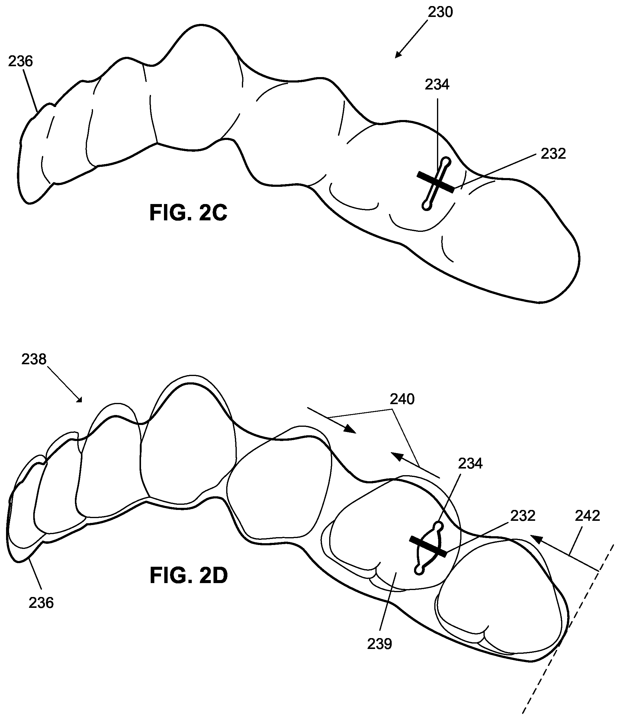 Patent US12376945 Figure 5 – Orthodontic appliances with discontinuities and elastics