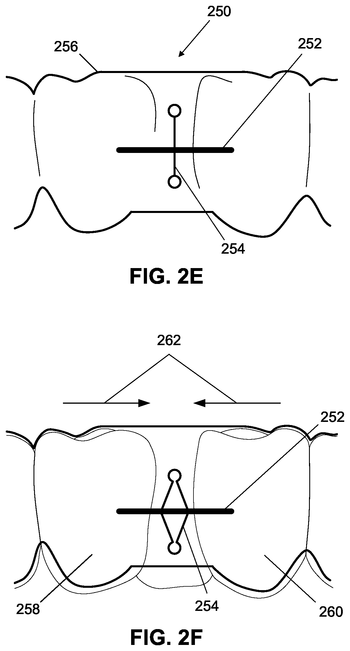 Patent US12376945 Figure 6 – Orthodontic appliances with discontinuities and elastics