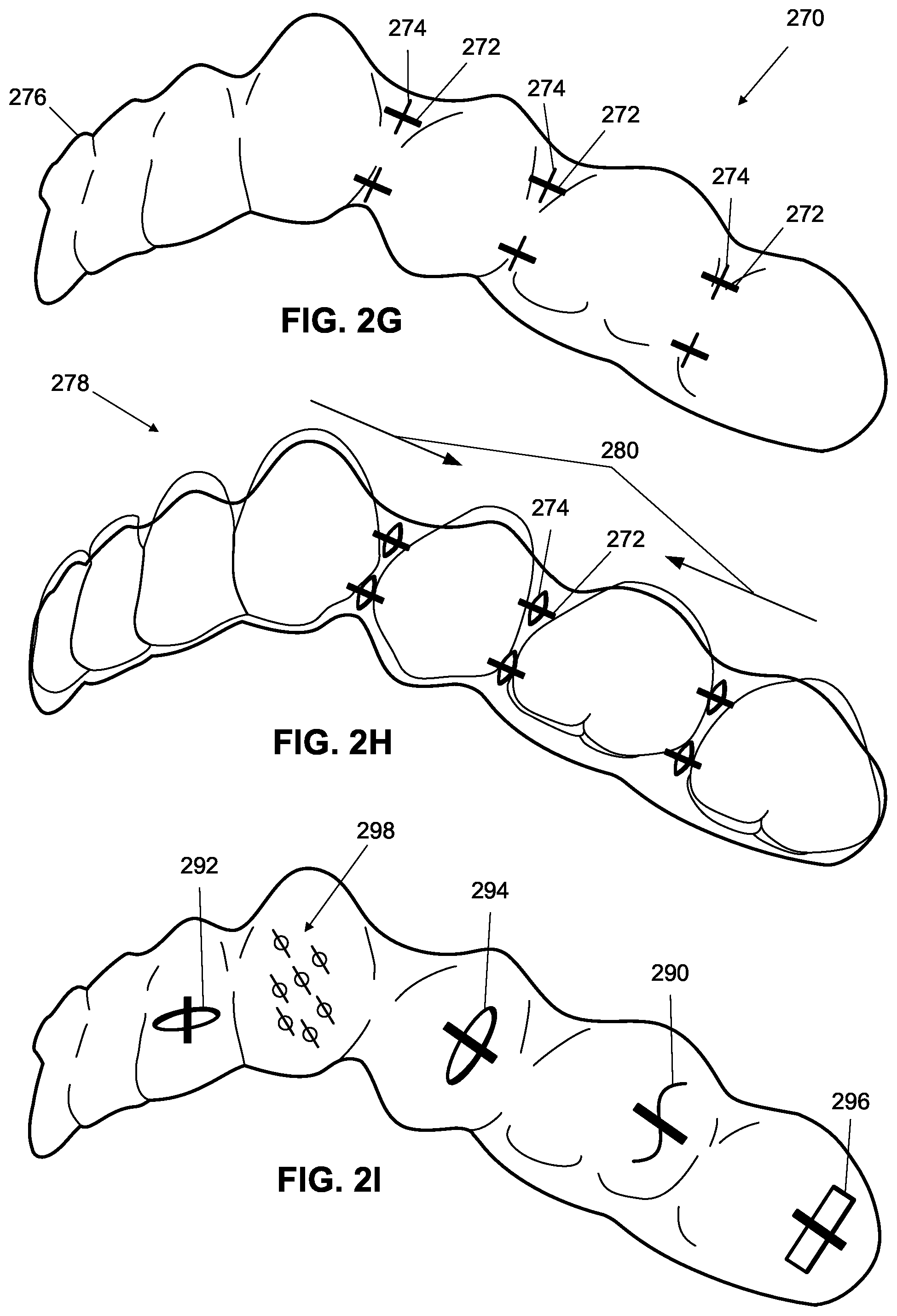 Patent US12376945 Figure 7 – Orthodontic appliances with discontinuities and elastics