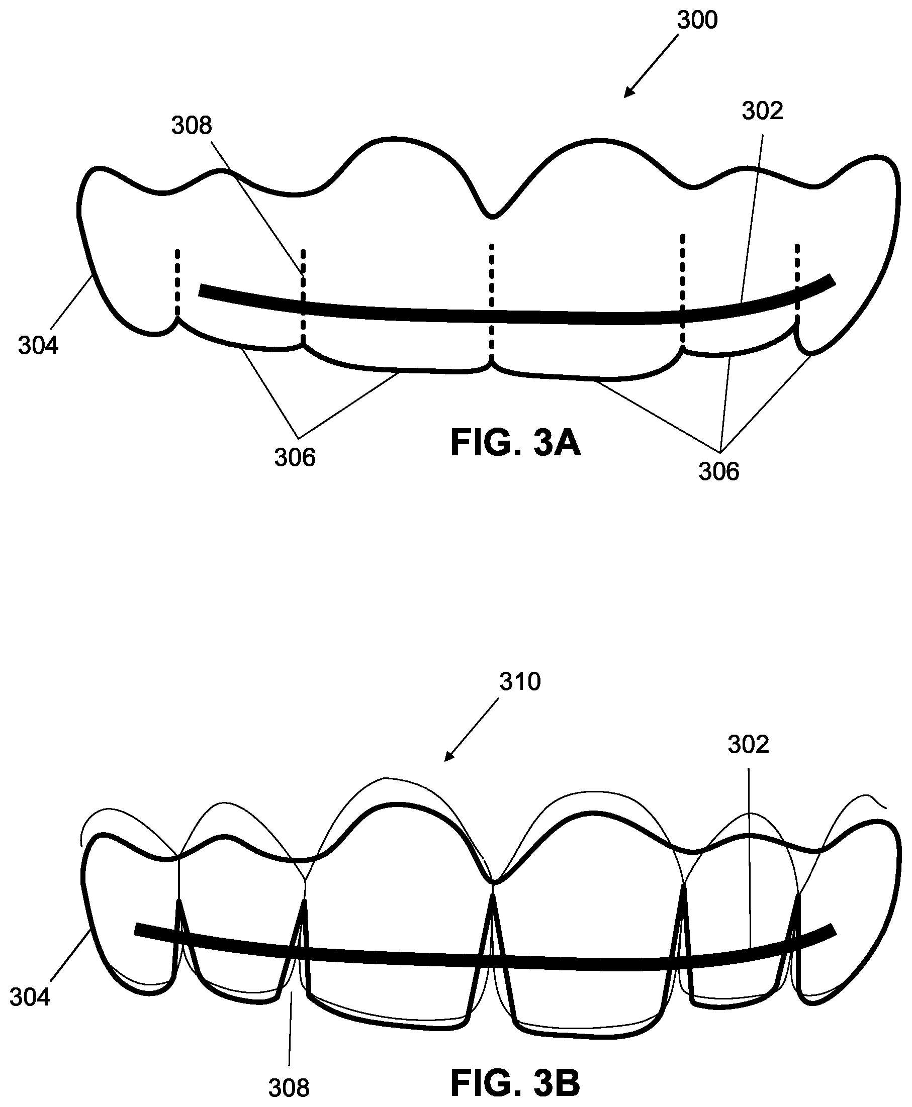 Patent US12376945 Figure 8 – Orthodontic appliances with discontinuities and elastics