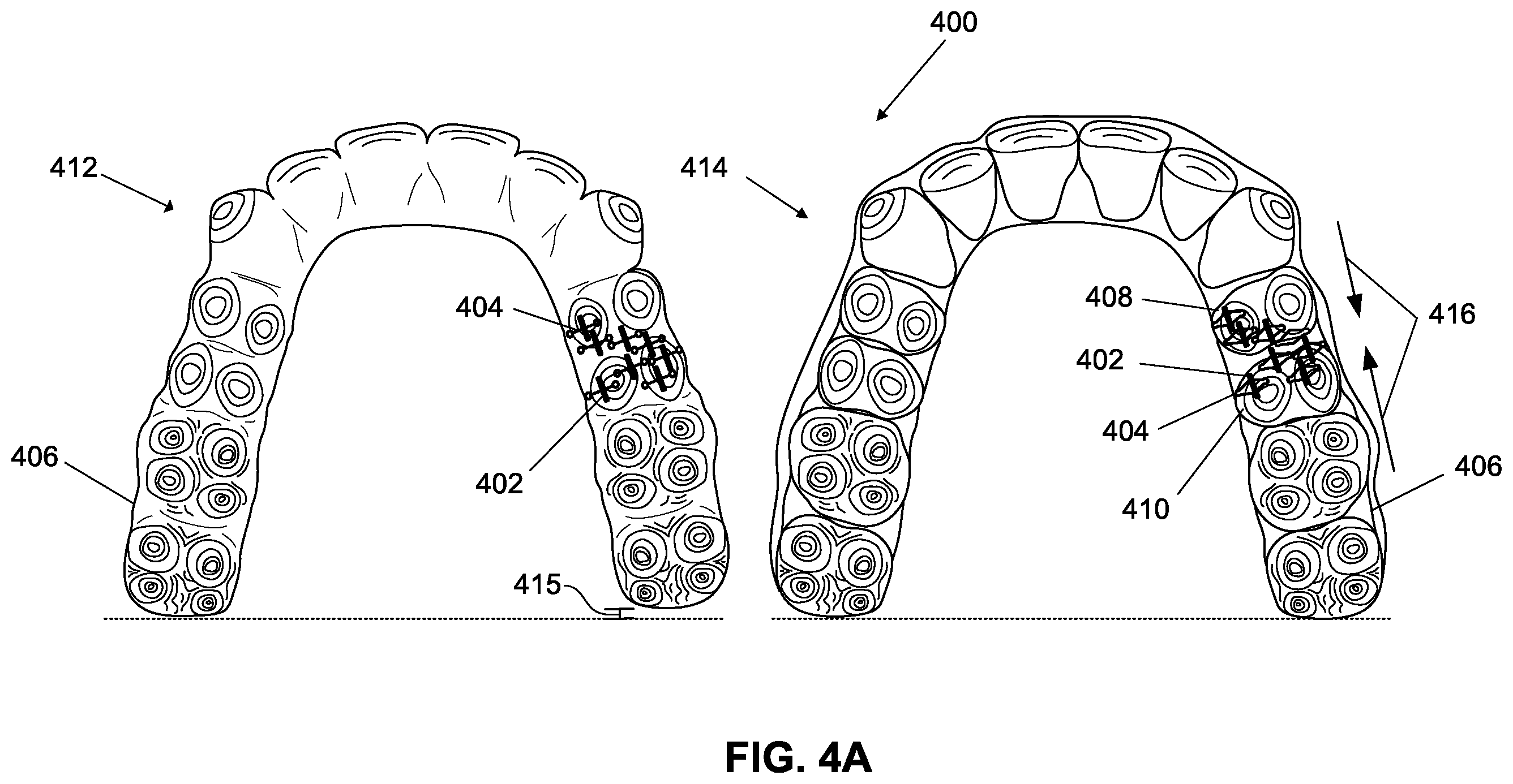 Patent US12376945 Figure 9 – Orthodontic appliances with discontinuities and elastics