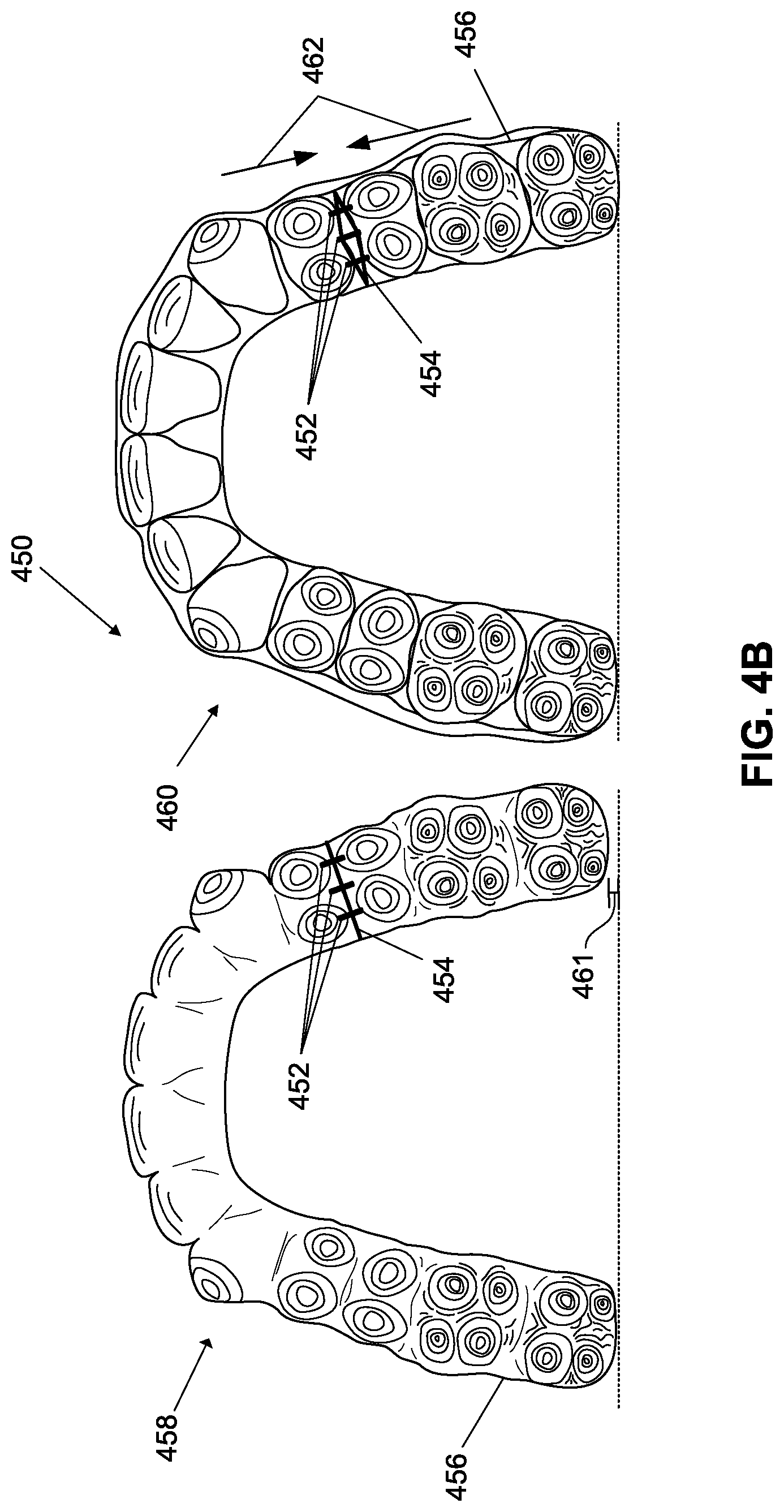 Patent US12376945 Figure 10 – Orthodontic appliances with discontinuities and elastics
