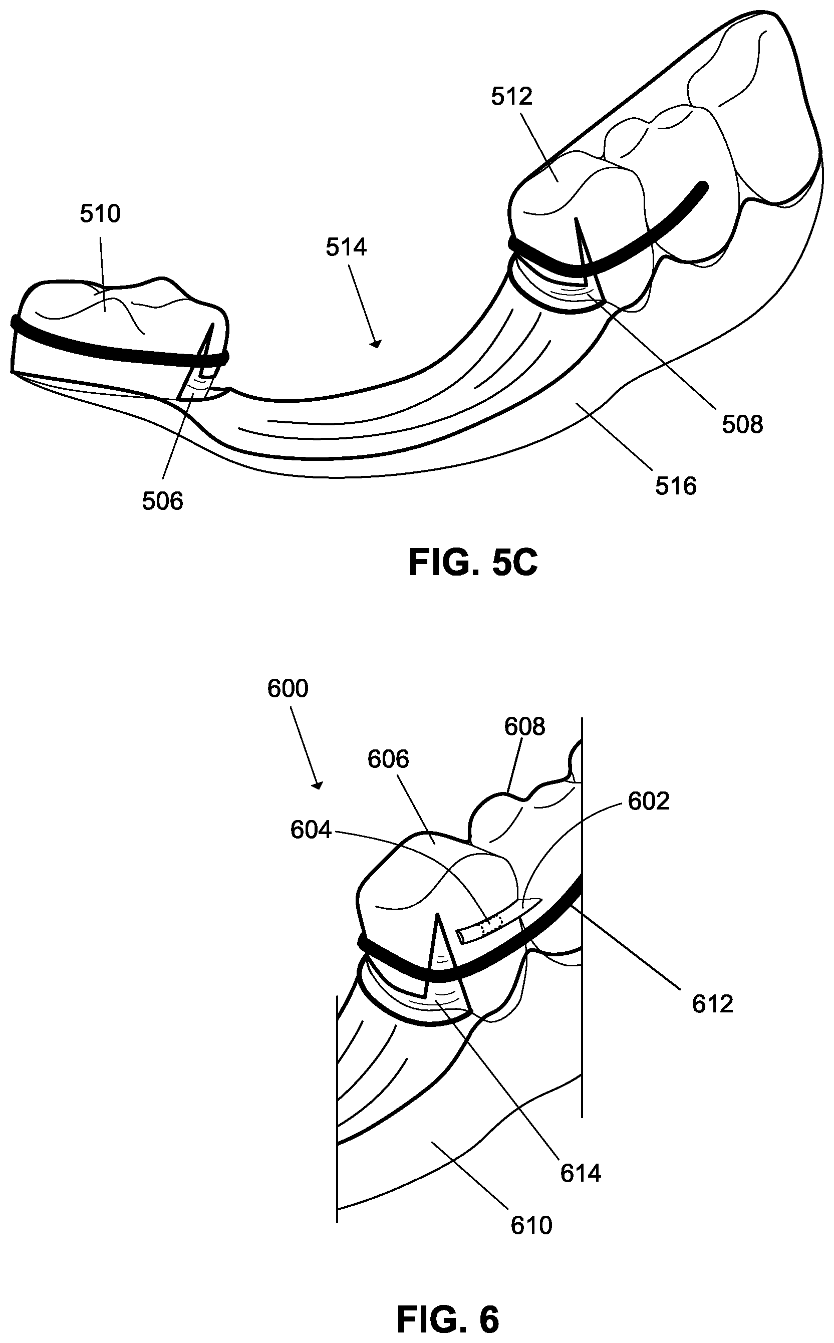Patent US12376945 Figure 12 – Orthodontic appliances with discontinuities and elastics