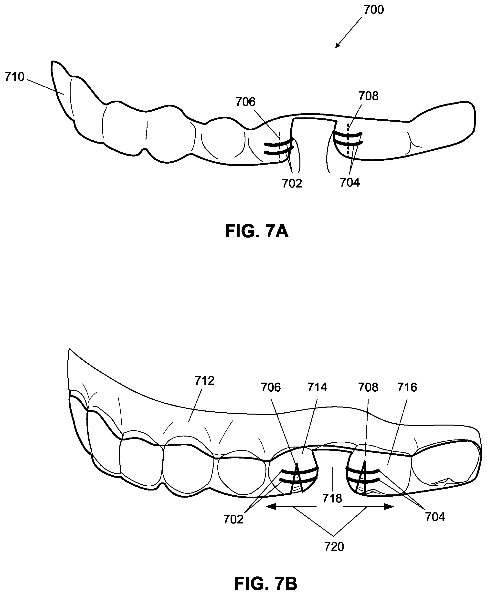 Patent US12376945 Figure 13 – Orthodontic appliances with discontinuities and elastics