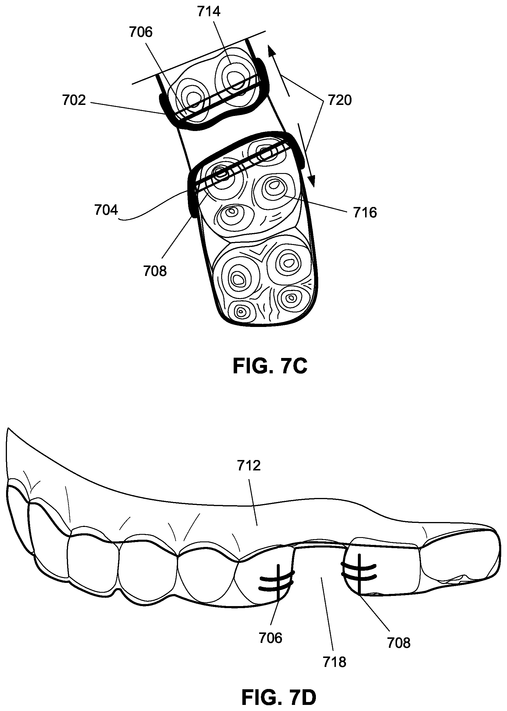 Patent US12376945 Figure 14 – Orthodontic appliances with discontinuities and elastics