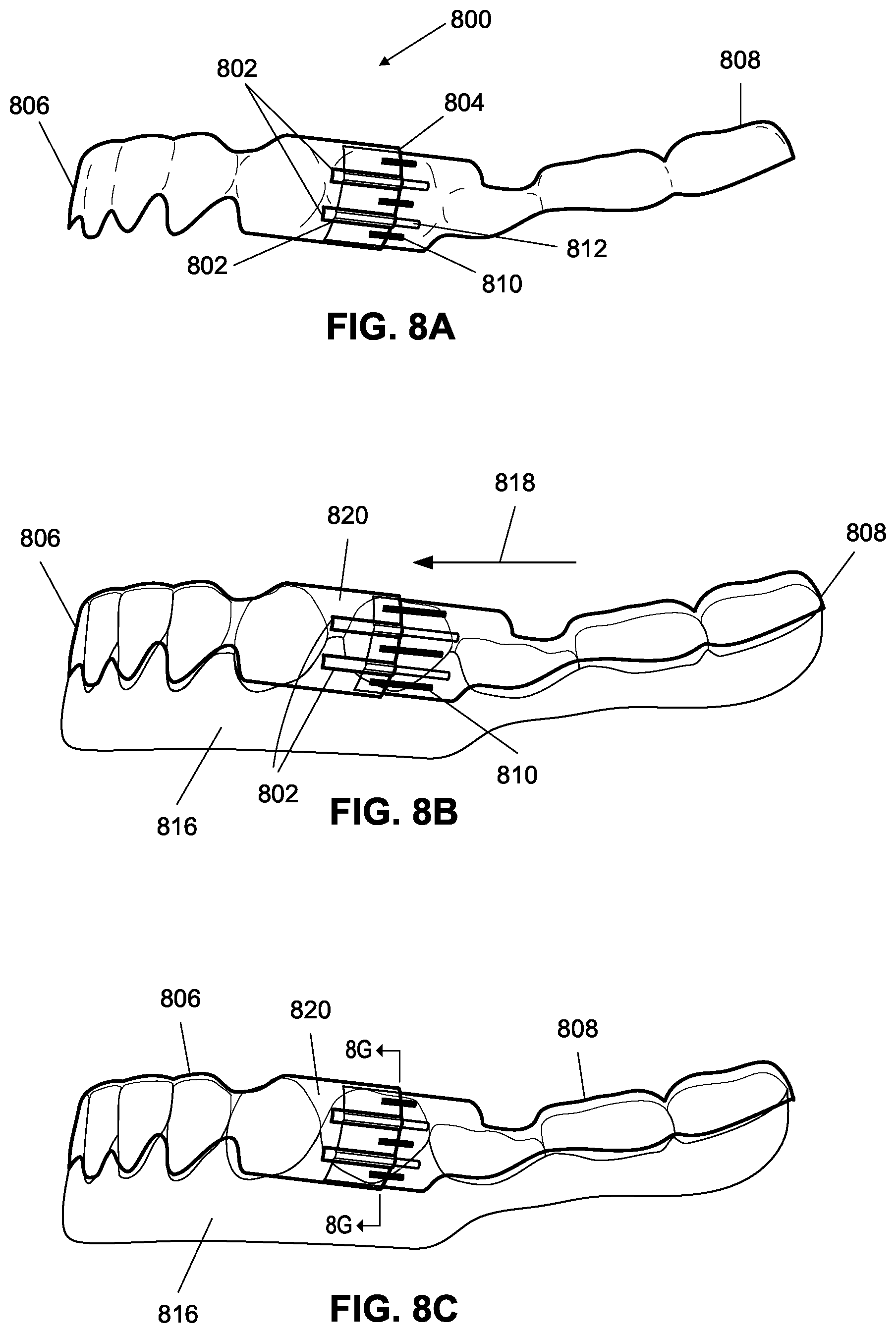 Patent US12376945 Figure 15 – Orthodontic appliances with discontinuities and elastics