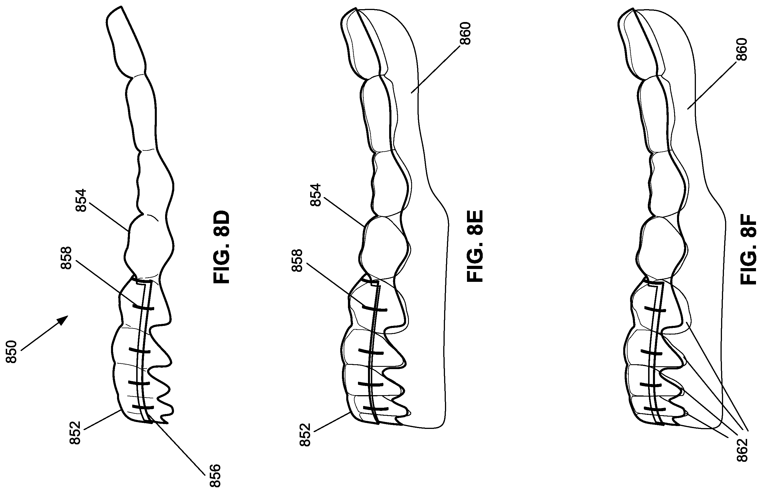 Patent US12376945 Figure 16 – Orthodontic appliances with discontinuities and elastics