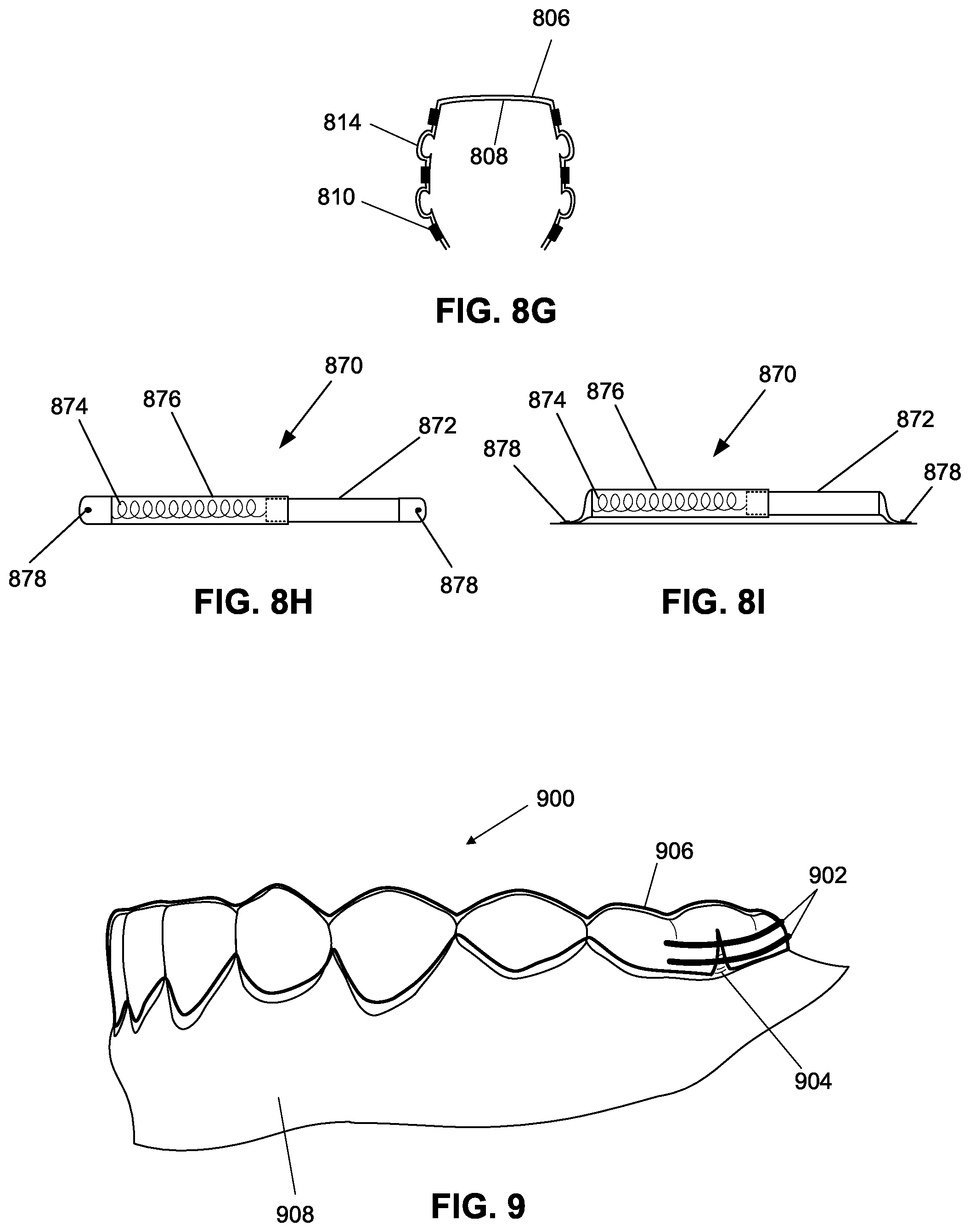 Patent US12376945 Figure 17 – Orthodontic appliances with discontinuities and elastics