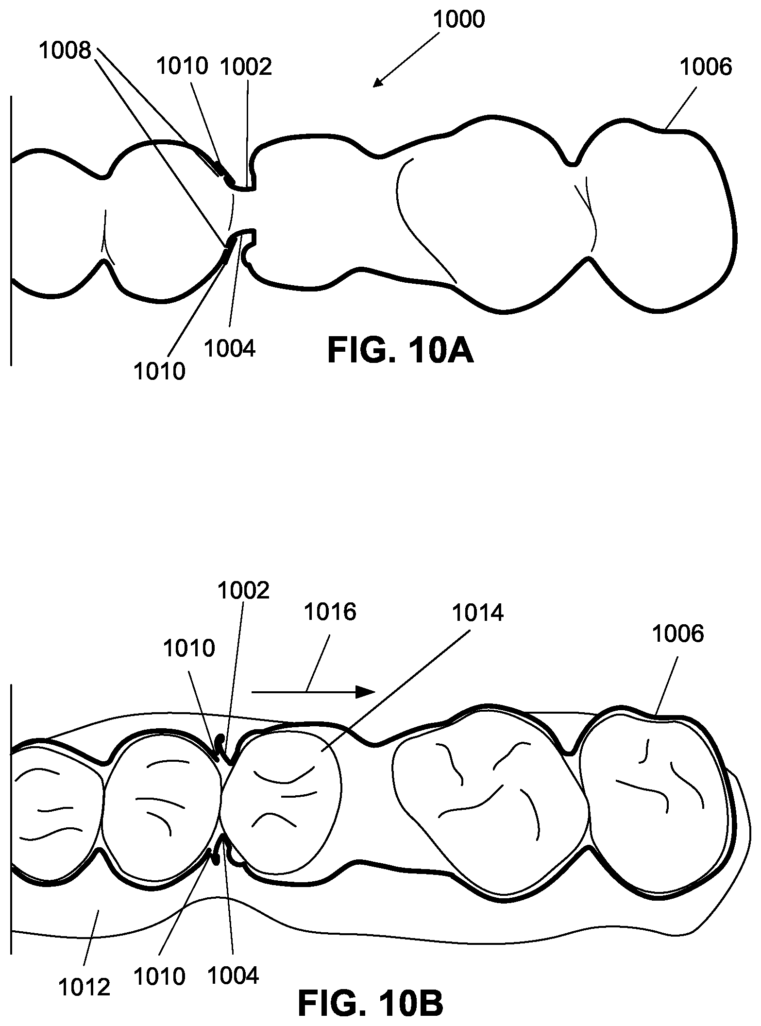 Patent US12376945 Figure 18 – Orthodontic appliances with discontinuities and elastics
