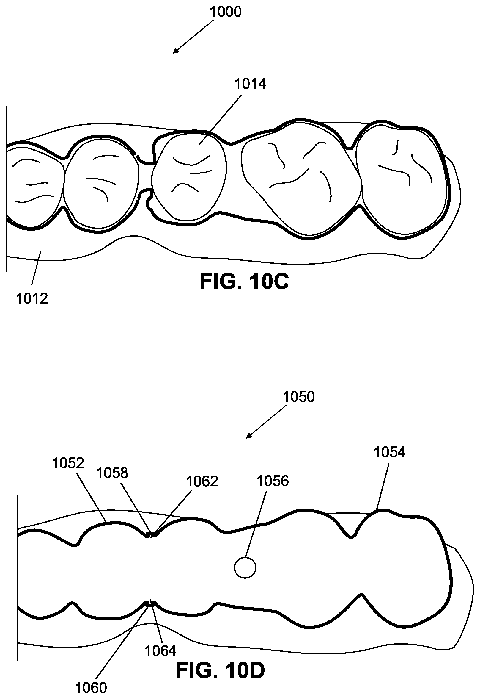 Patent US12376945 Figure 19 – Orthodontic appliances with discontinuities and elastics