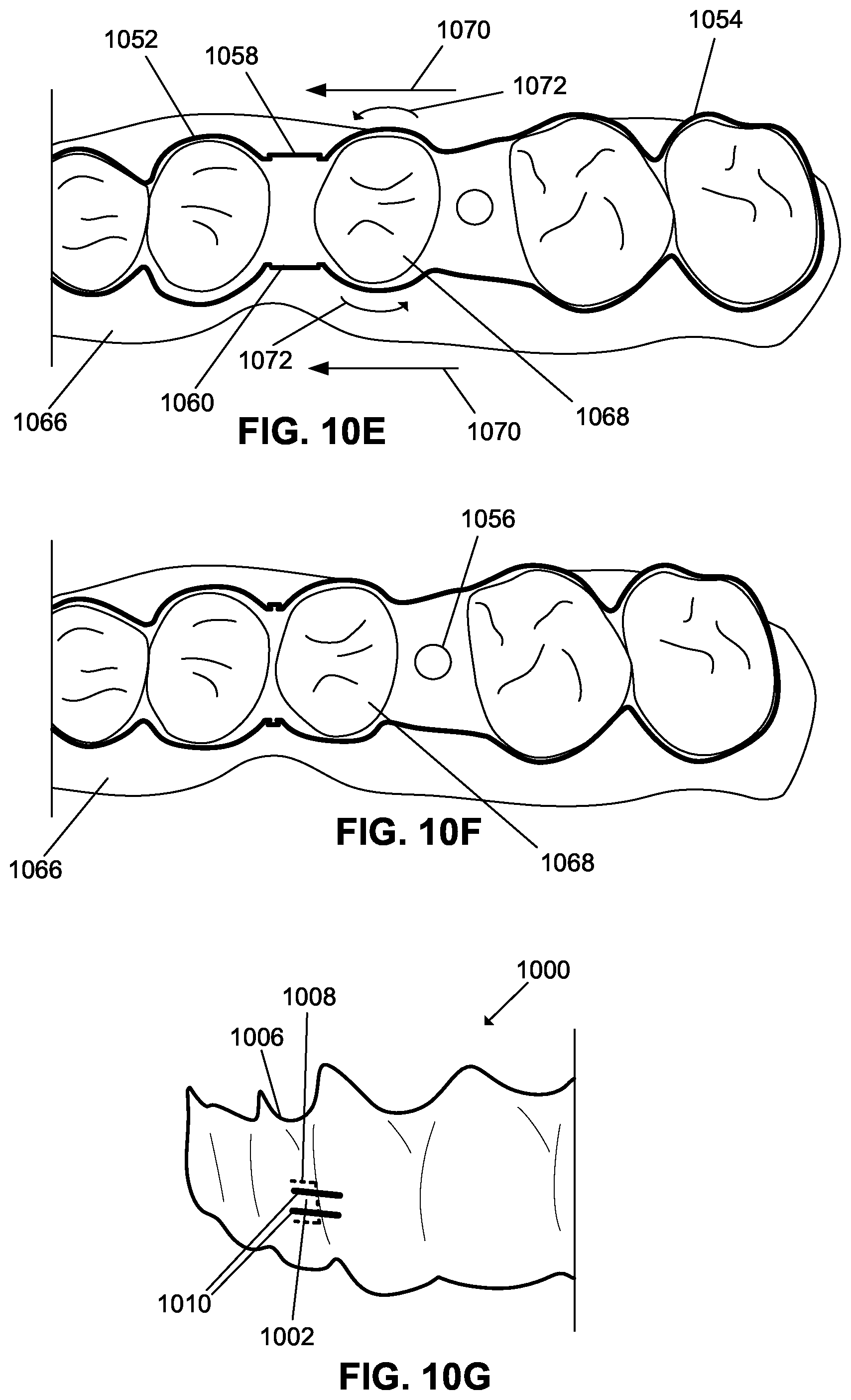 Patent US12376945 Figure 20 – Orthodontic appliances with discontinuities and elastics