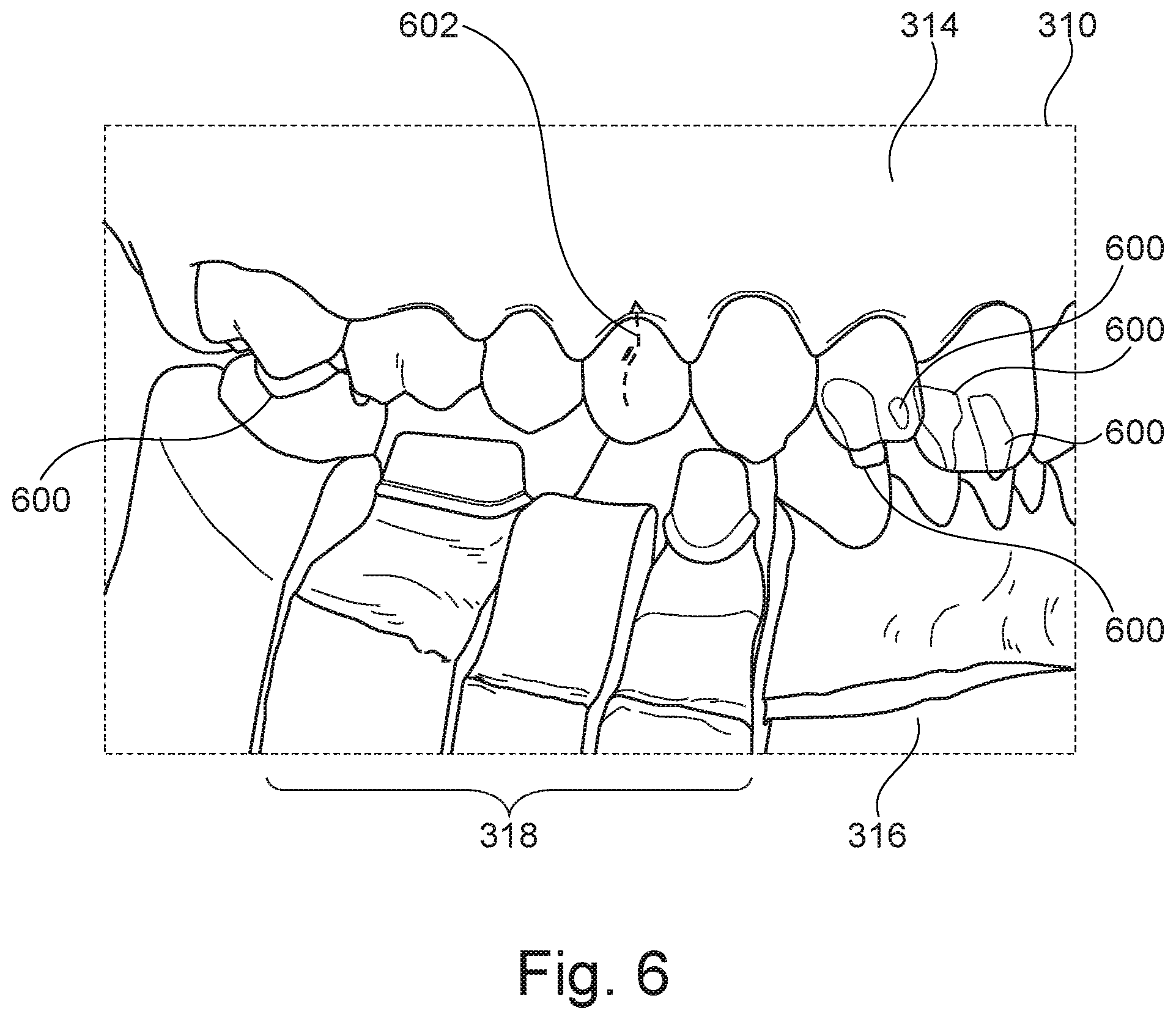 Patent US12376946 Figure 6 – Control of virtual objects using a dental articulator
