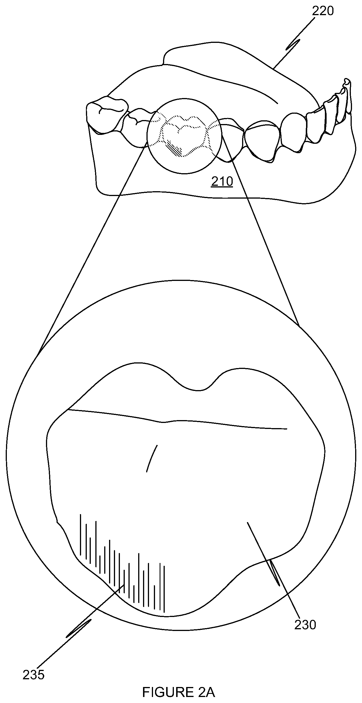 Patent US12376948 Figure 2 – Ultrasonic cleaning device