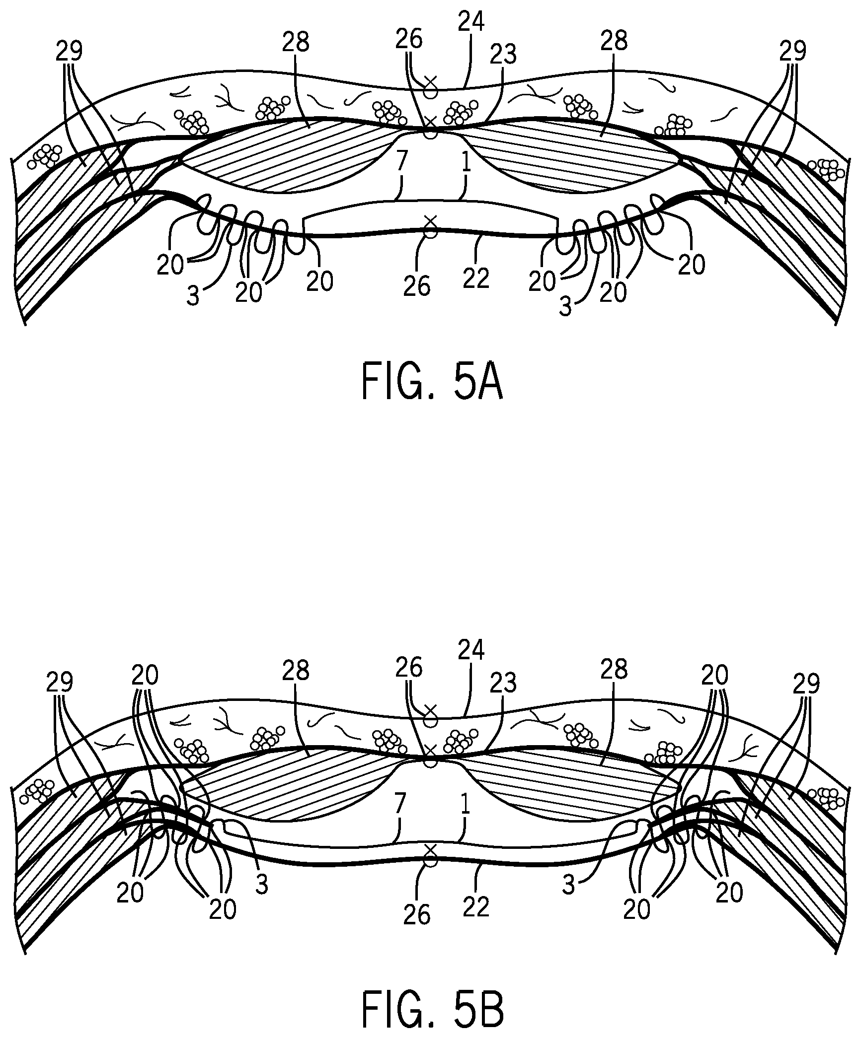 Patent US12376954 Figure 3 – Implantable mesh and method of use