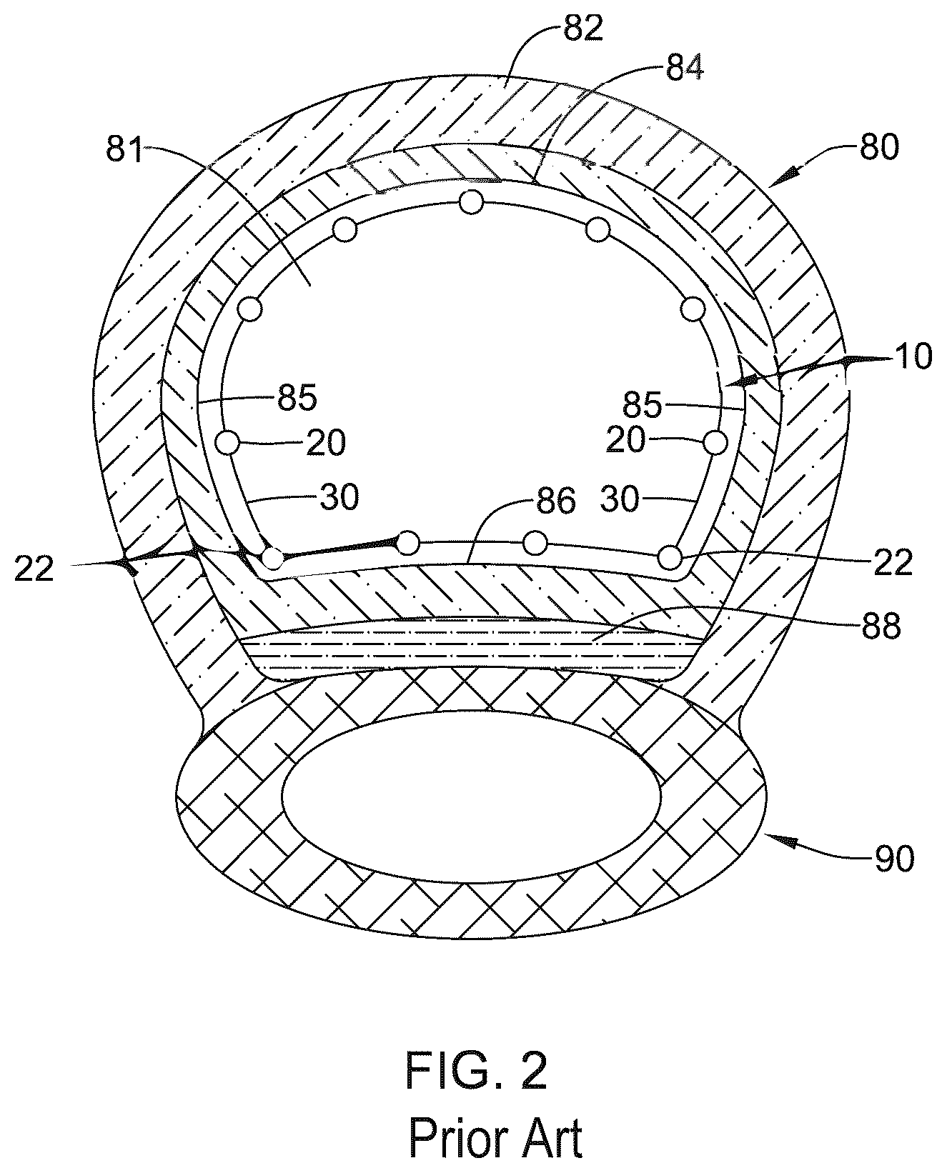 Patent US12376955 Figure 2 – Endoprosthesis with stress reducing features