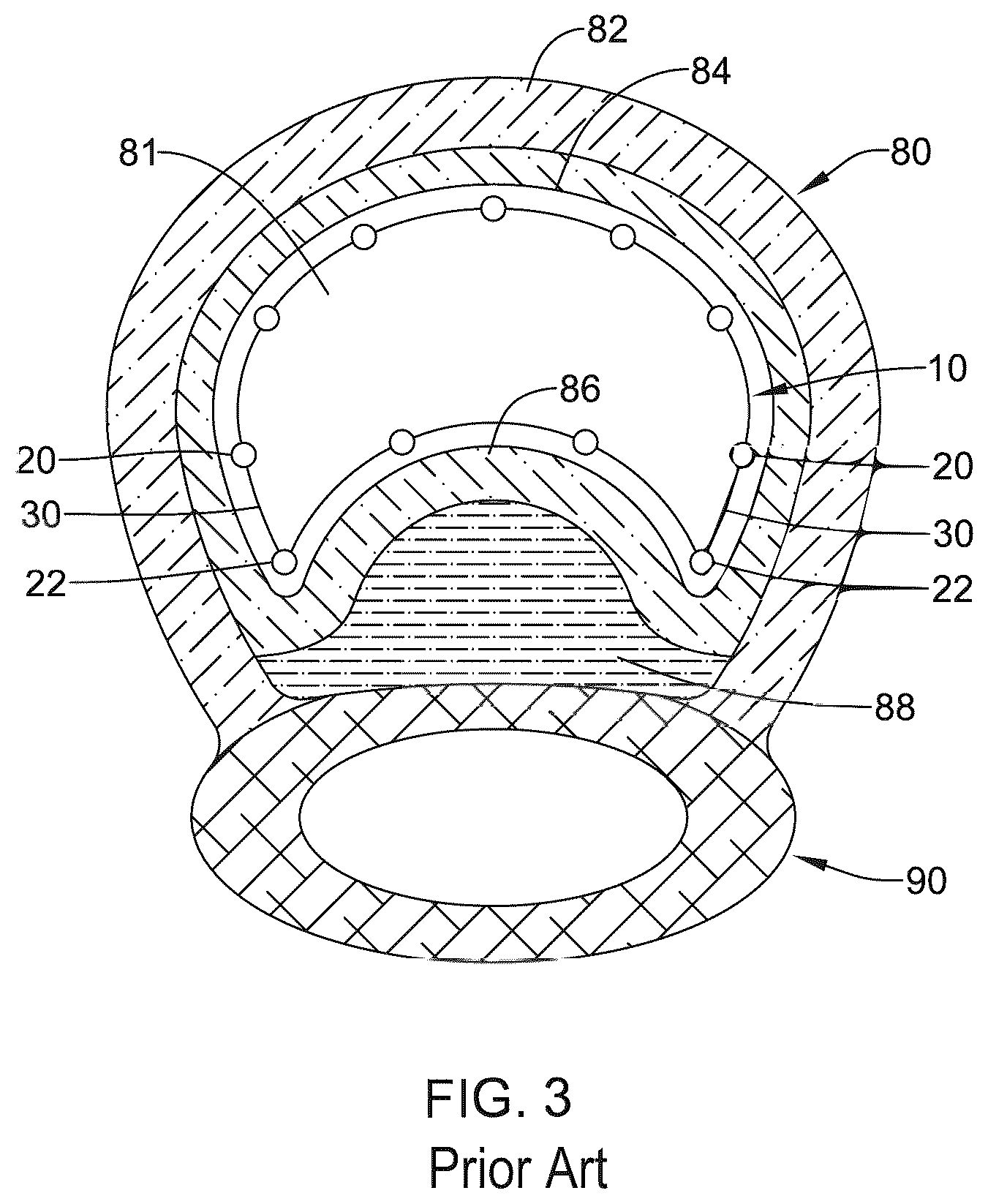 Patent US12376955 Figure 3 – Endoprosthesis with stress reducing features
