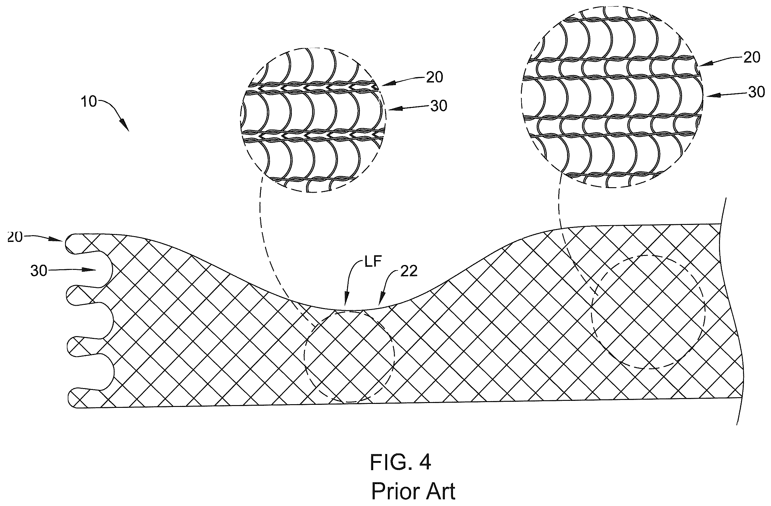 Patent US12376955 Figure 4 – Endoprosthesis with stress reducing features