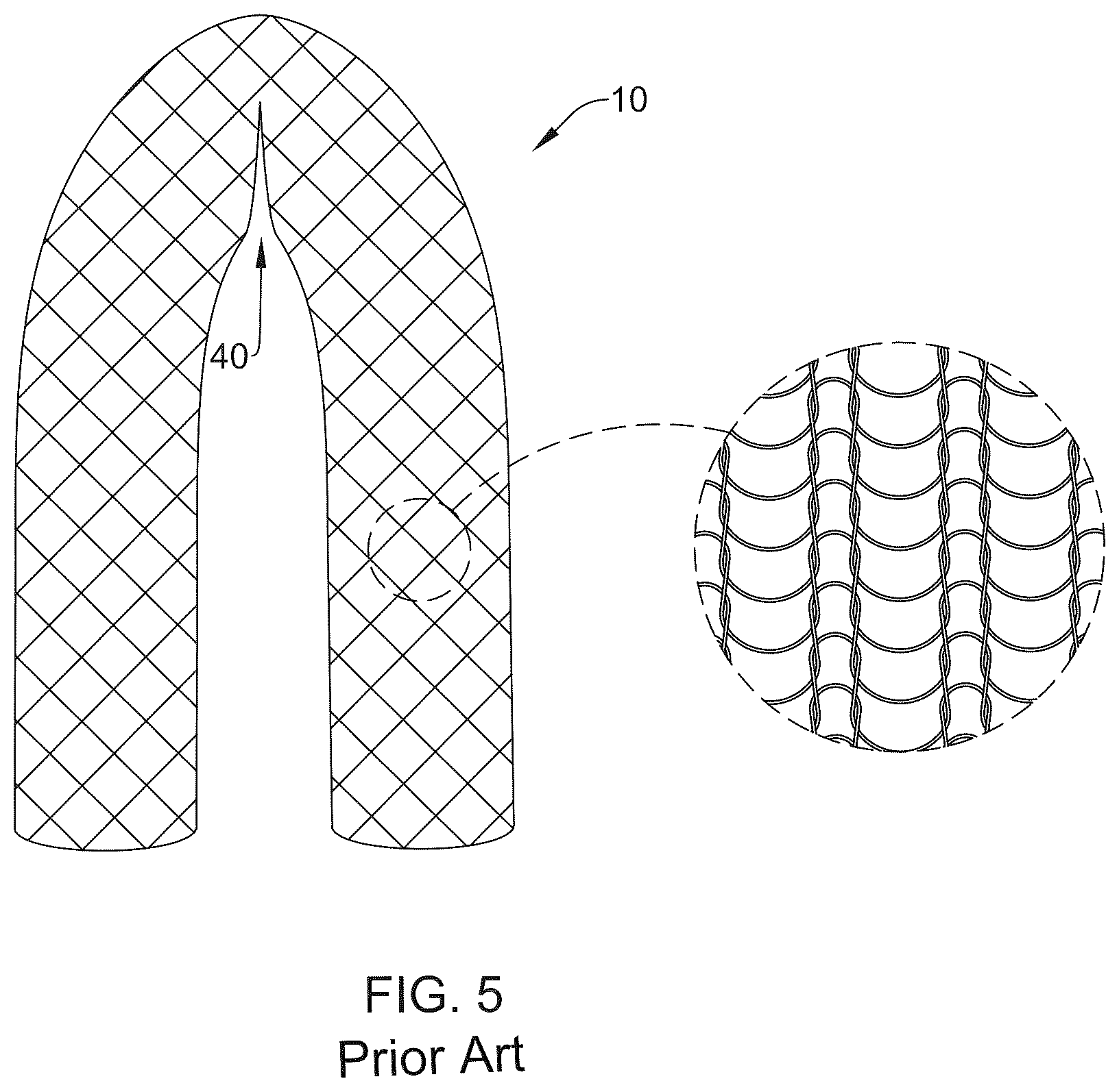 Patent US12376955 Figure 5 – Endoprosthesis with stress reducing features