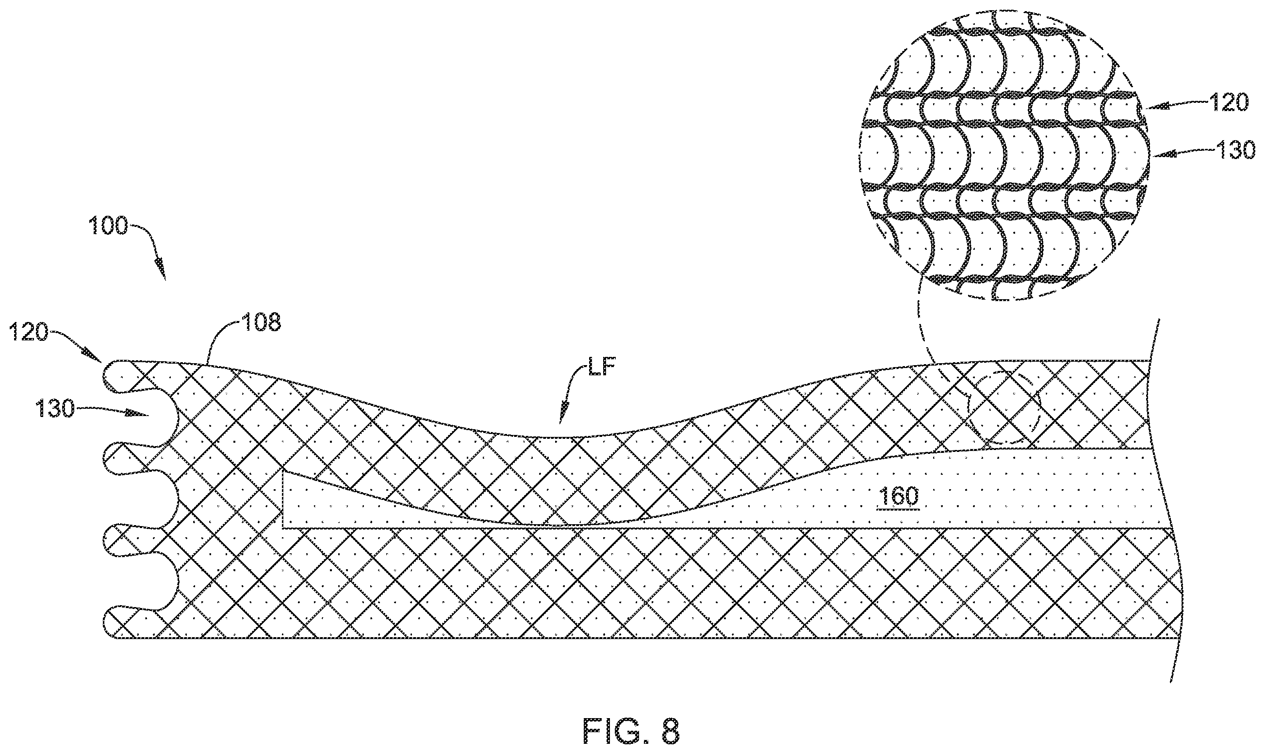 Patent US12376955 Figure 8 – Endoprosthesis with stress reducing features