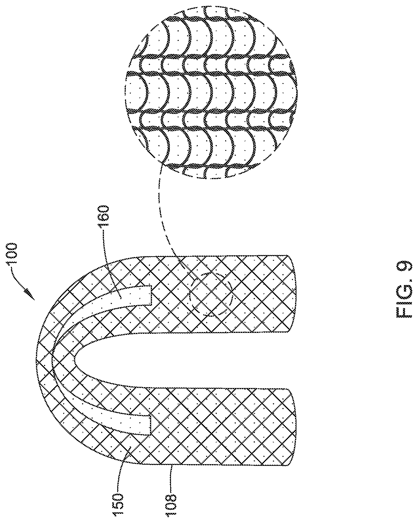 Patent US12376955 Figure 9 – Endoprosthesis with stress reducing features
