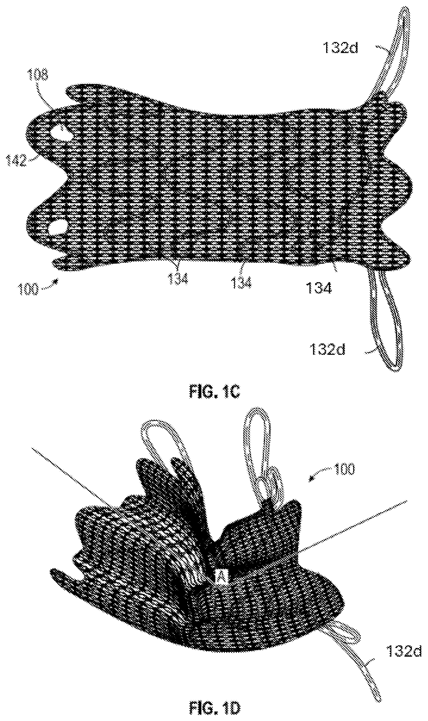 Patent US12376956 Figure 2 – Percutaneous shunt devices and related methods
