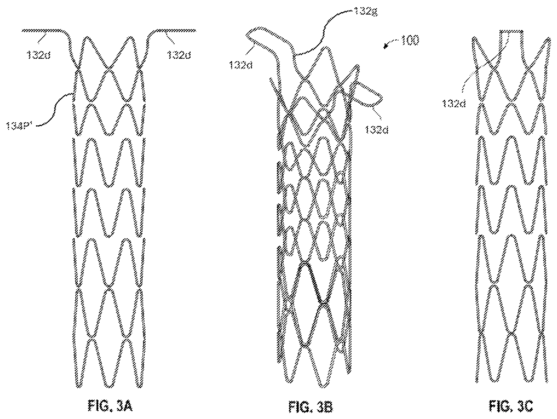 Patent US12376956 Figure 6 – Percutaneous shunt devices and related methods