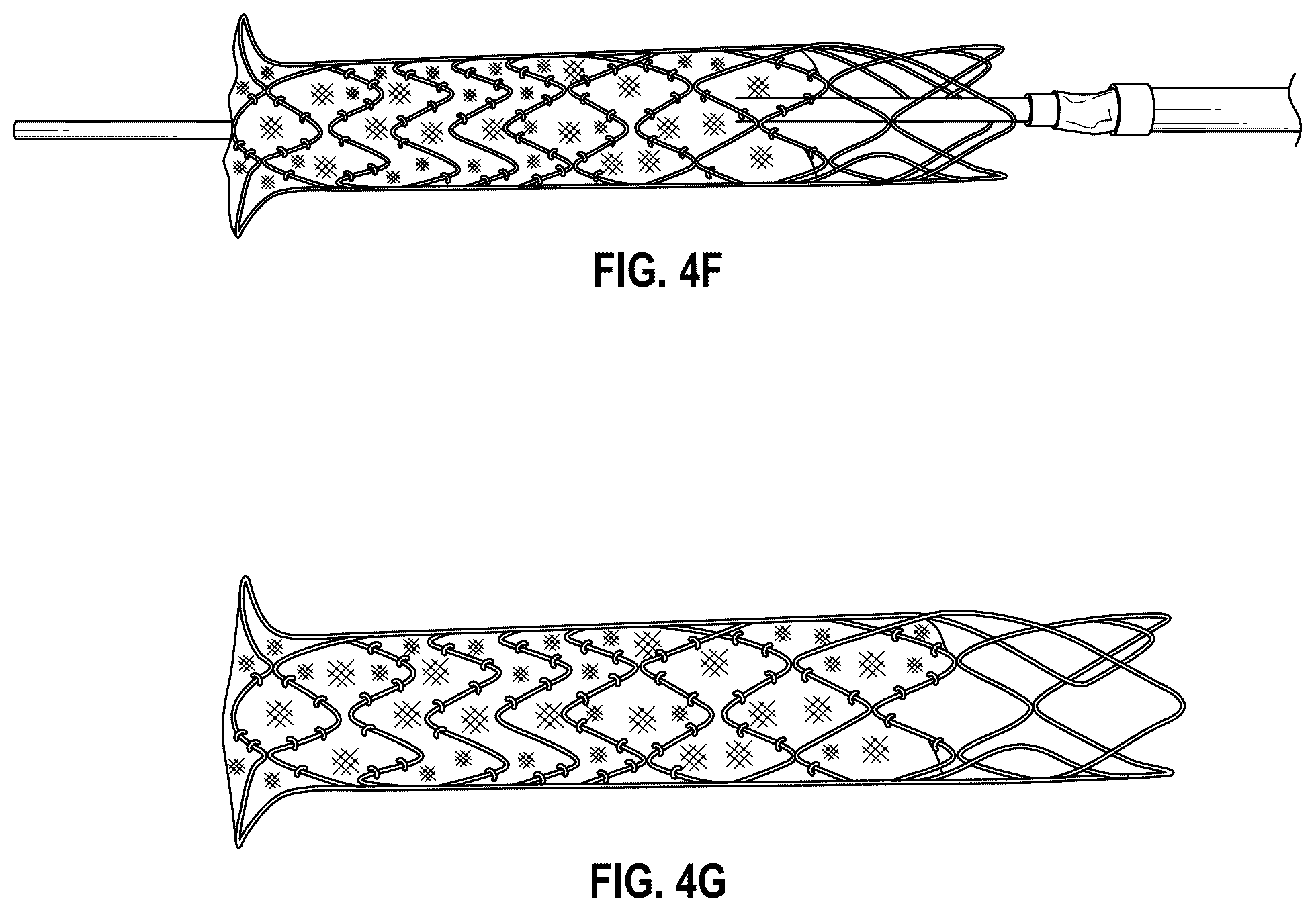 Patent US12376956 Figure 9 – Percutaneous shunt devices and related methods