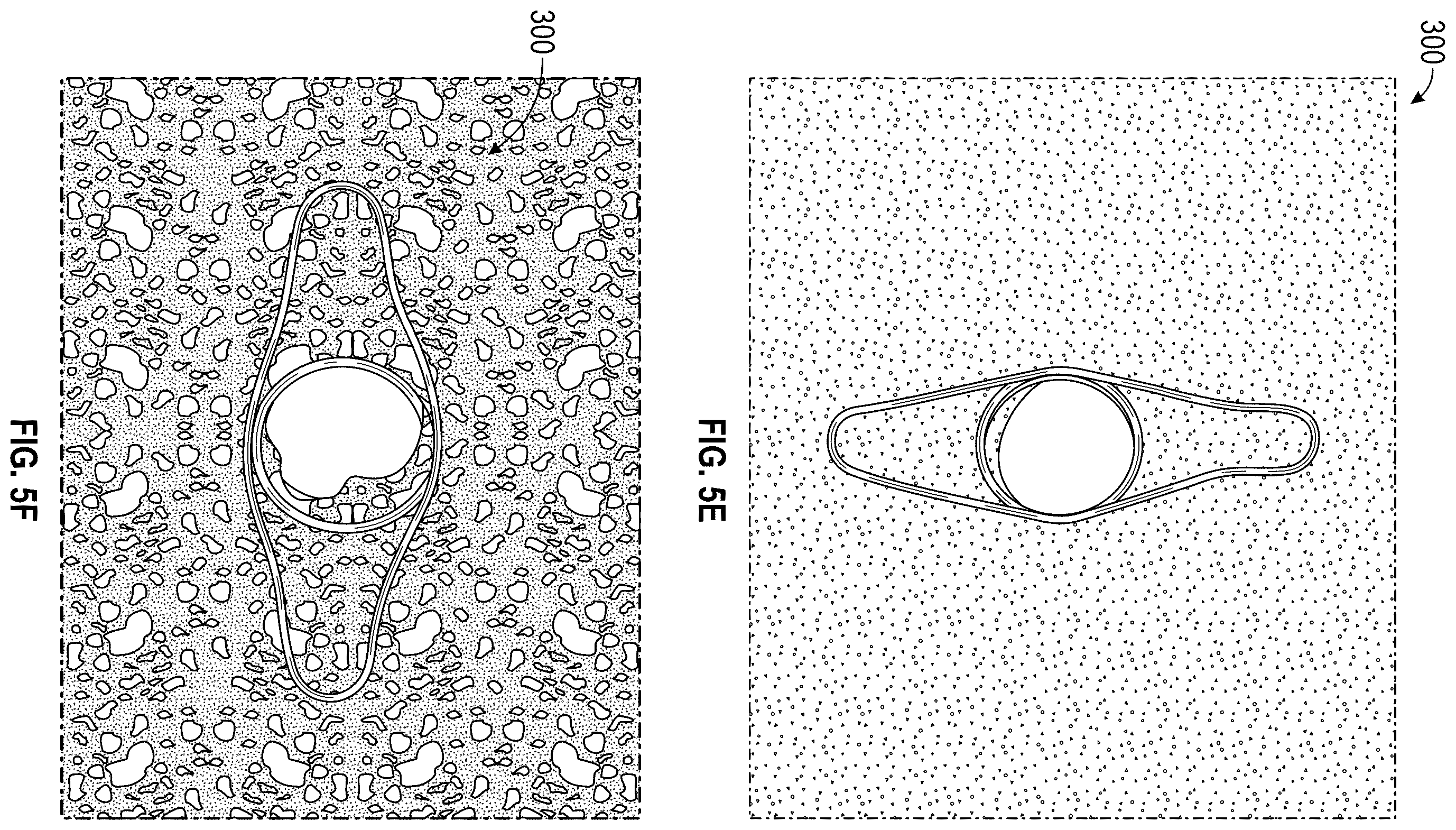 Patent US12376956 Figure 13 – Percutaneous shunt devices and related methods