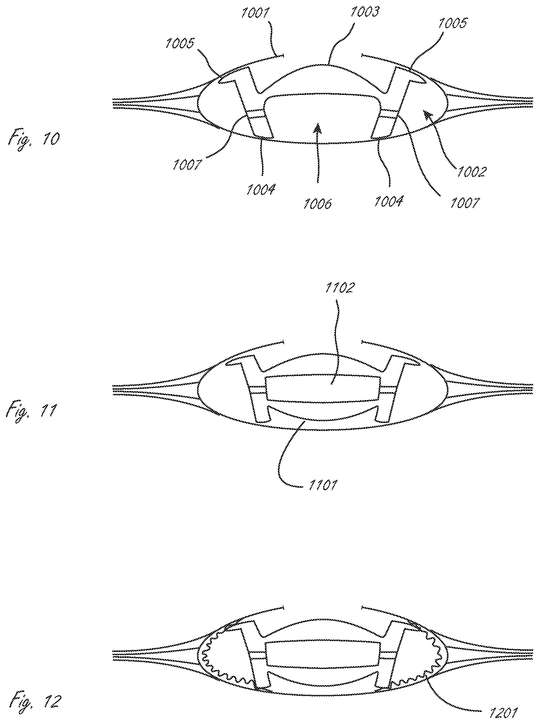 Patent US12376957 Figure 3 – Multi-piece accommodating intraocular lens