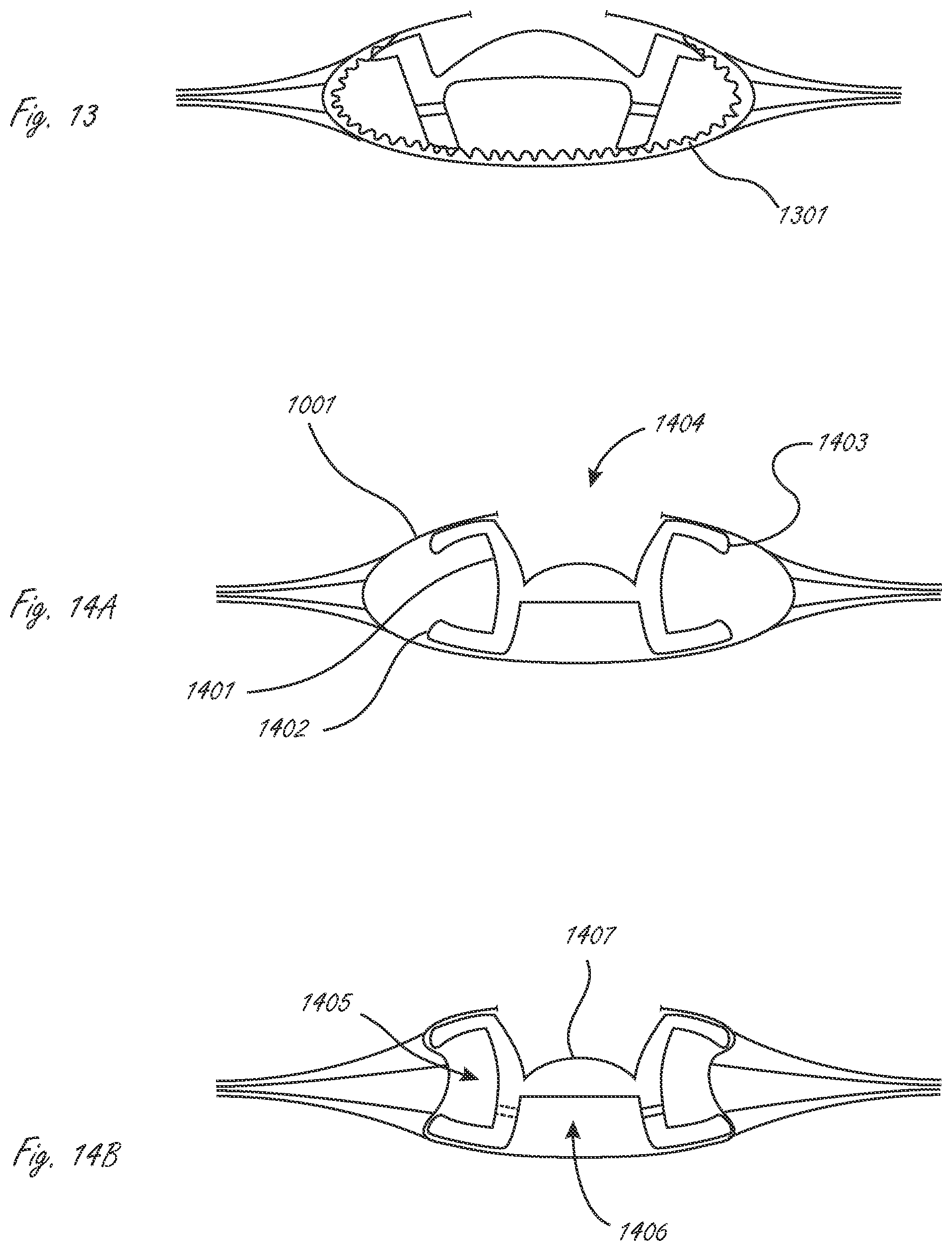 Patent US12376957 Figure 4 – Multi-piece accommodating intraocular lens