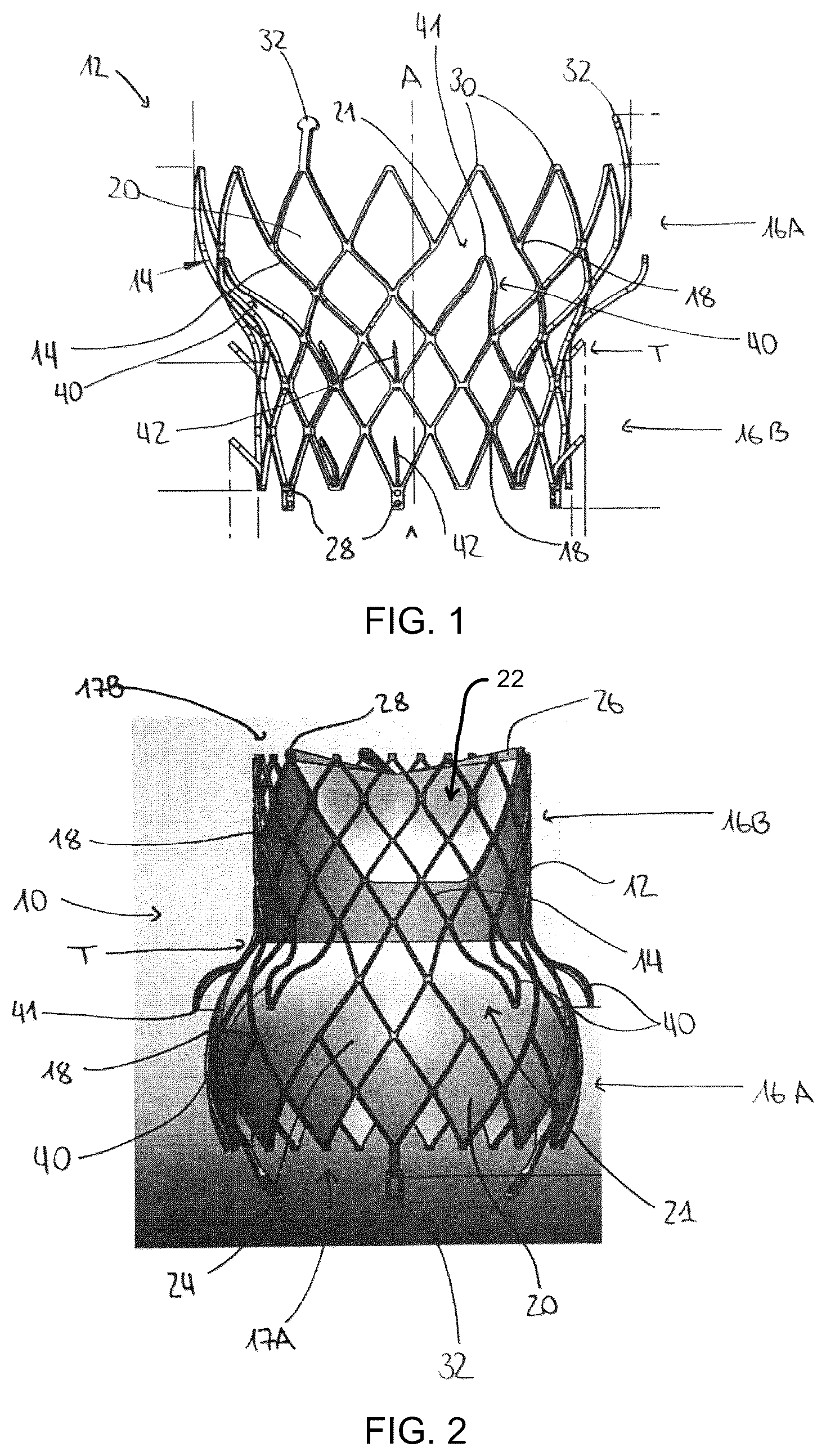Patent US12376960 — Mitral stent — Figure 1