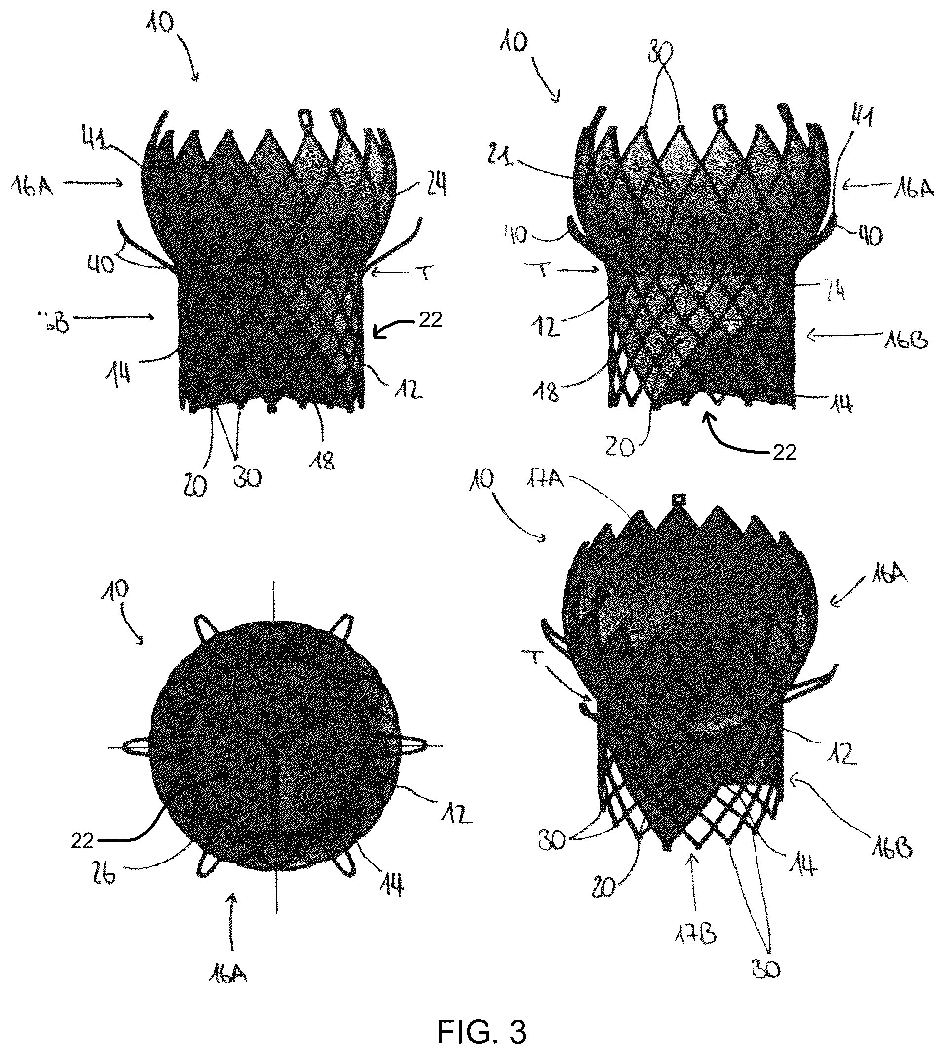 Patent US12376960 Figure 2 – Mitral stent