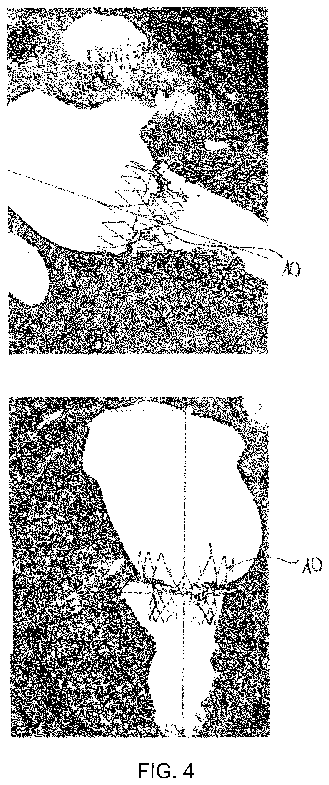 Patent US12376960 Figure 3 – Mitral stent