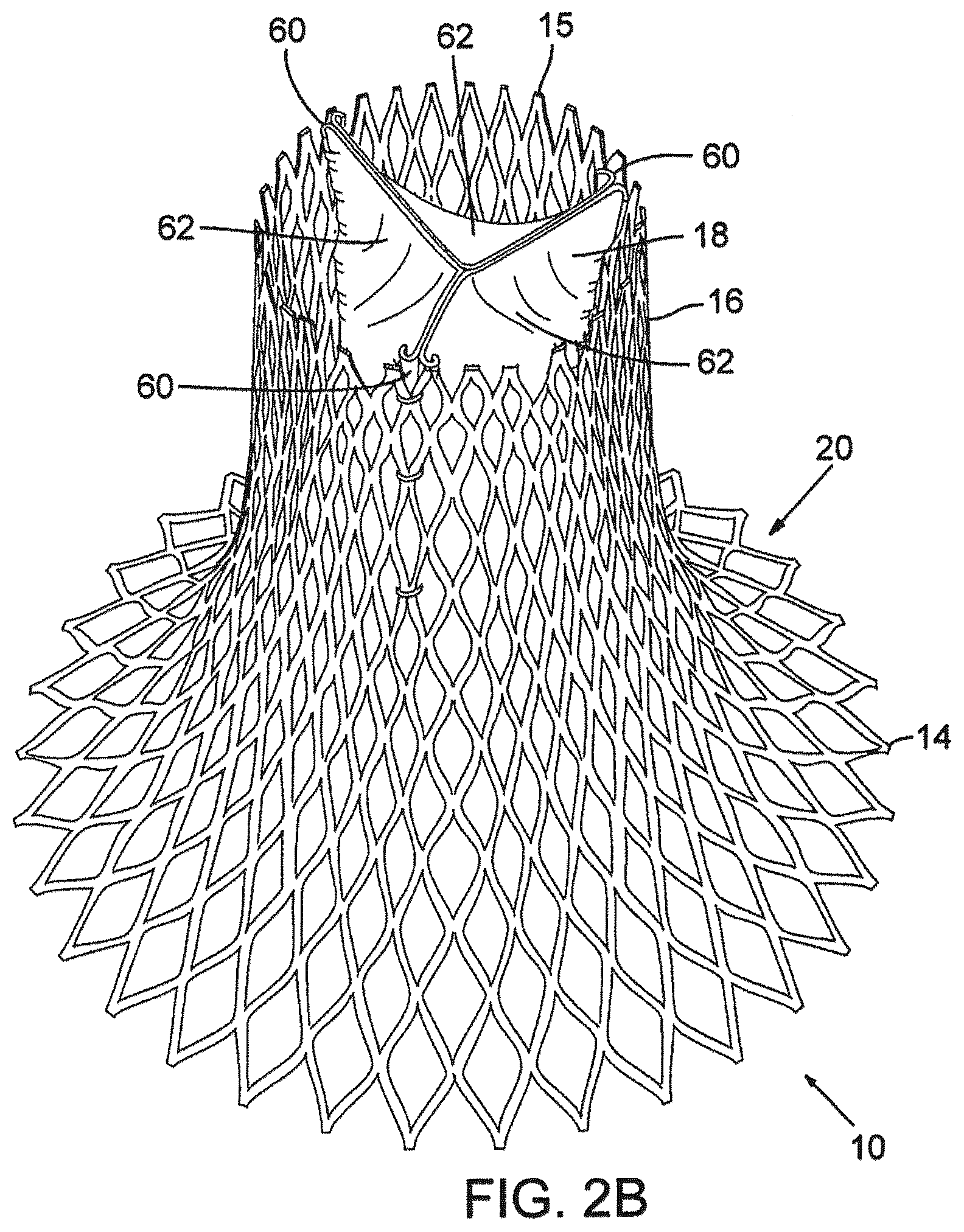 Patent US12376961 Figure 3 – Method of implanting a prosthetic heart valve assembly