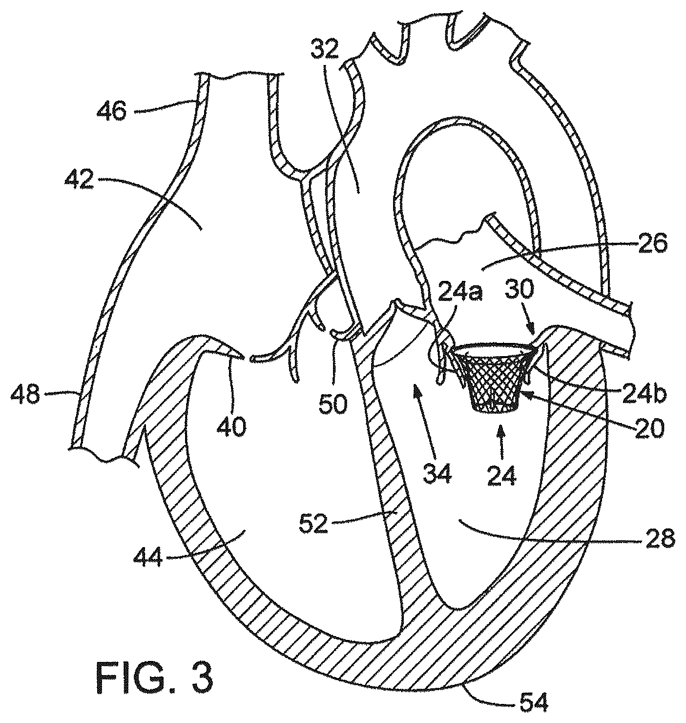 Patent US12376961 Figure 4 – Method of implanting a prosthetic heart valve assembly